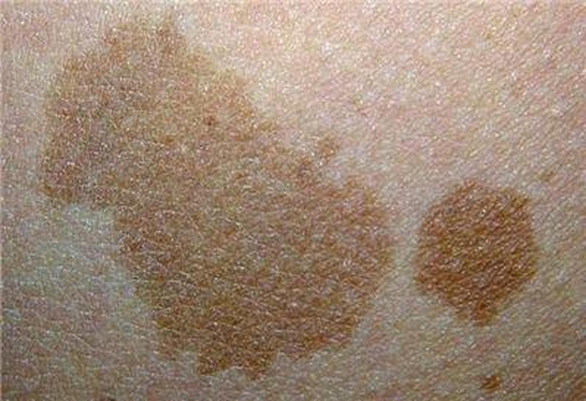 褐色斑块叫什么皮肤病图片