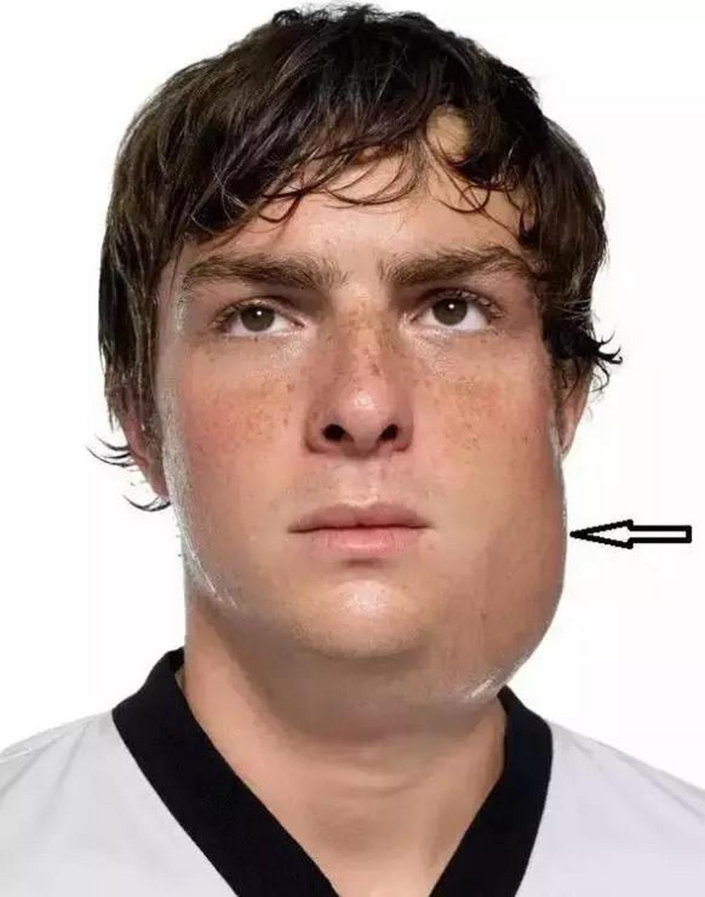 慢性阻塞性腮腺炎的病发原因?