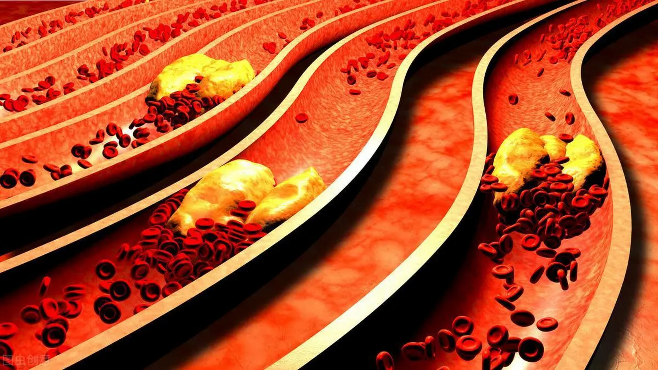 血管淤堵的人,晨起时有这5个表现,占2个以上,就要警惕了!