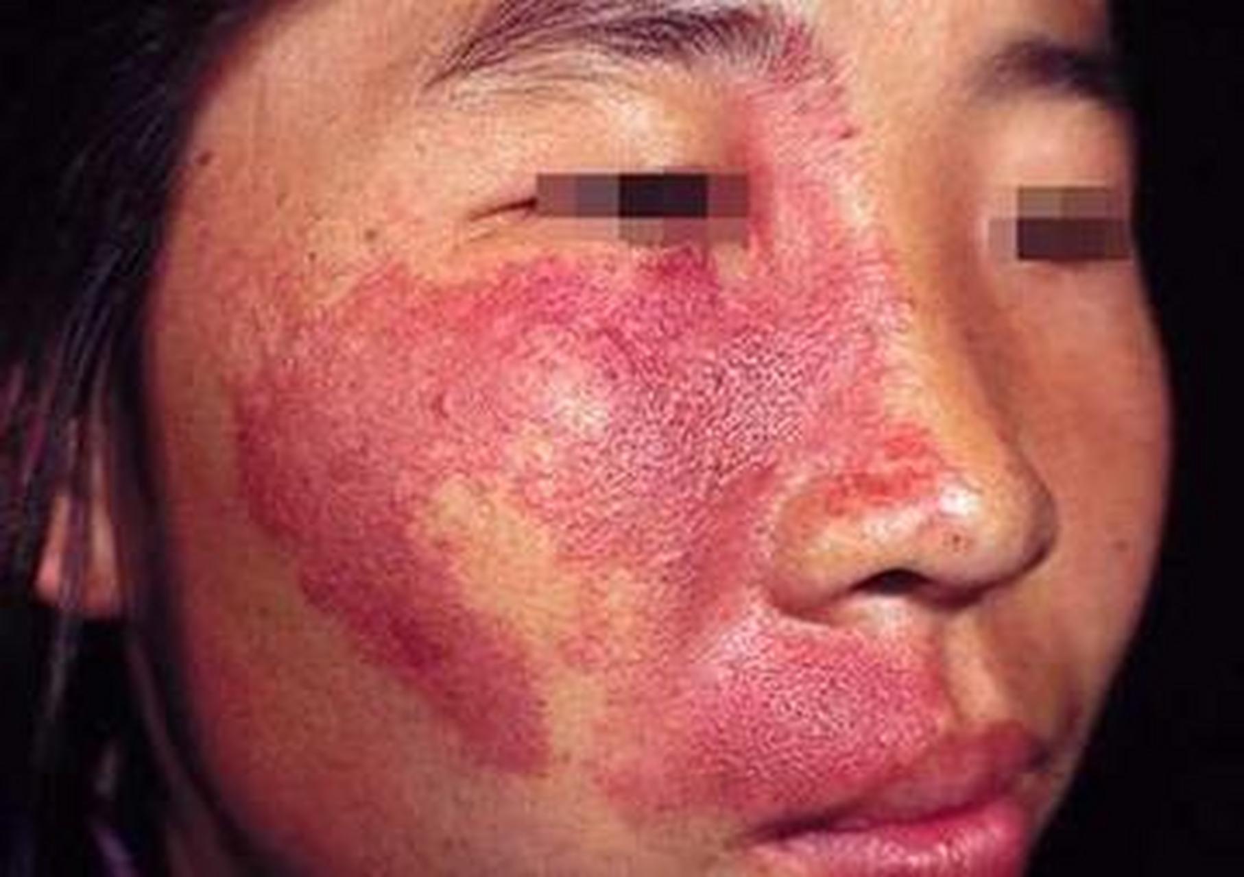 激光治疗鲜红斑痣  有关鲜红斑痣形成的原因,目前尚不完全清楚.