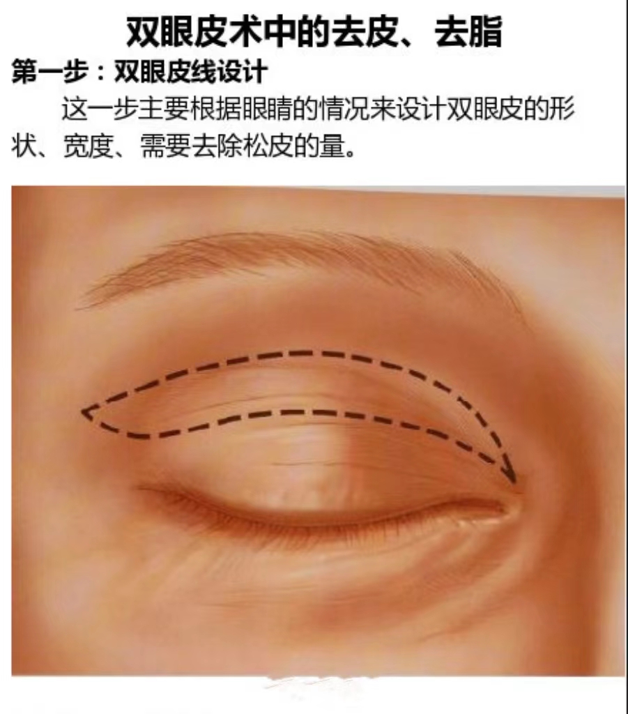 双眼皮术前设计画线图图片