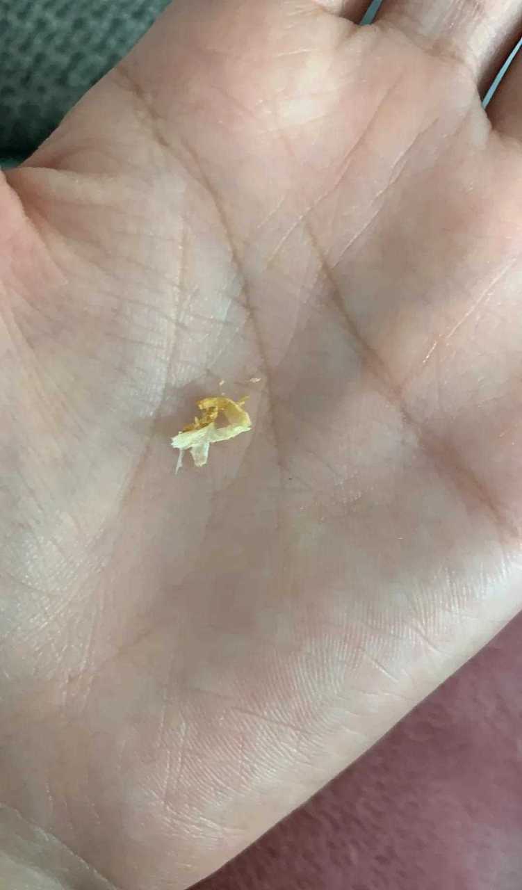 一岁半宝宝耳朵里掏出来的耳耵聍(耳屎)   @可乐妈辅食分享[抠鼻]