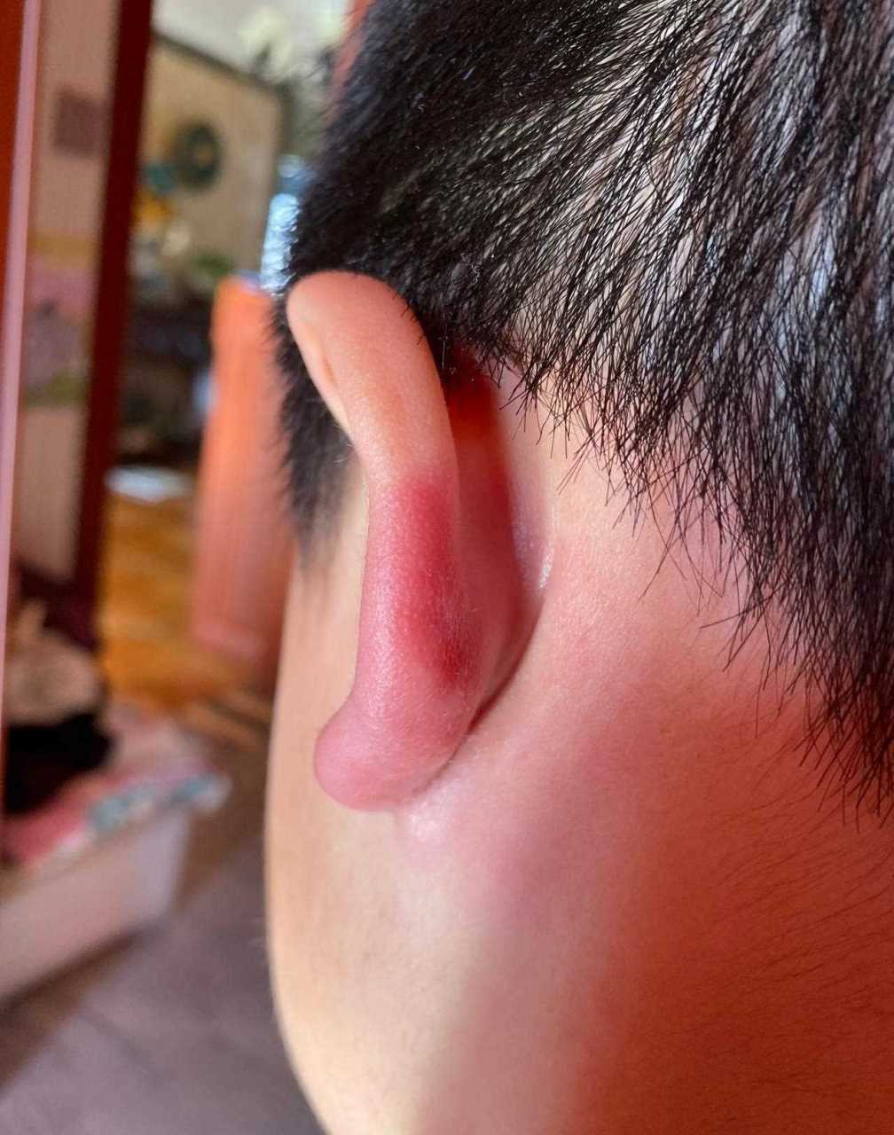 姥姥带娃昨天放学回家脱衣服说耳朵疼,我一看这咋肿成这样啊,没有看出