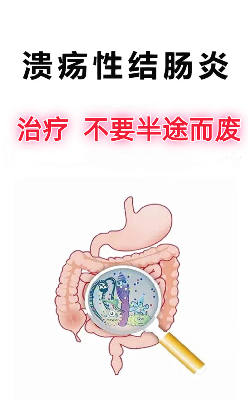 溃疡性结肠炎,治疗千万不要半途而废!