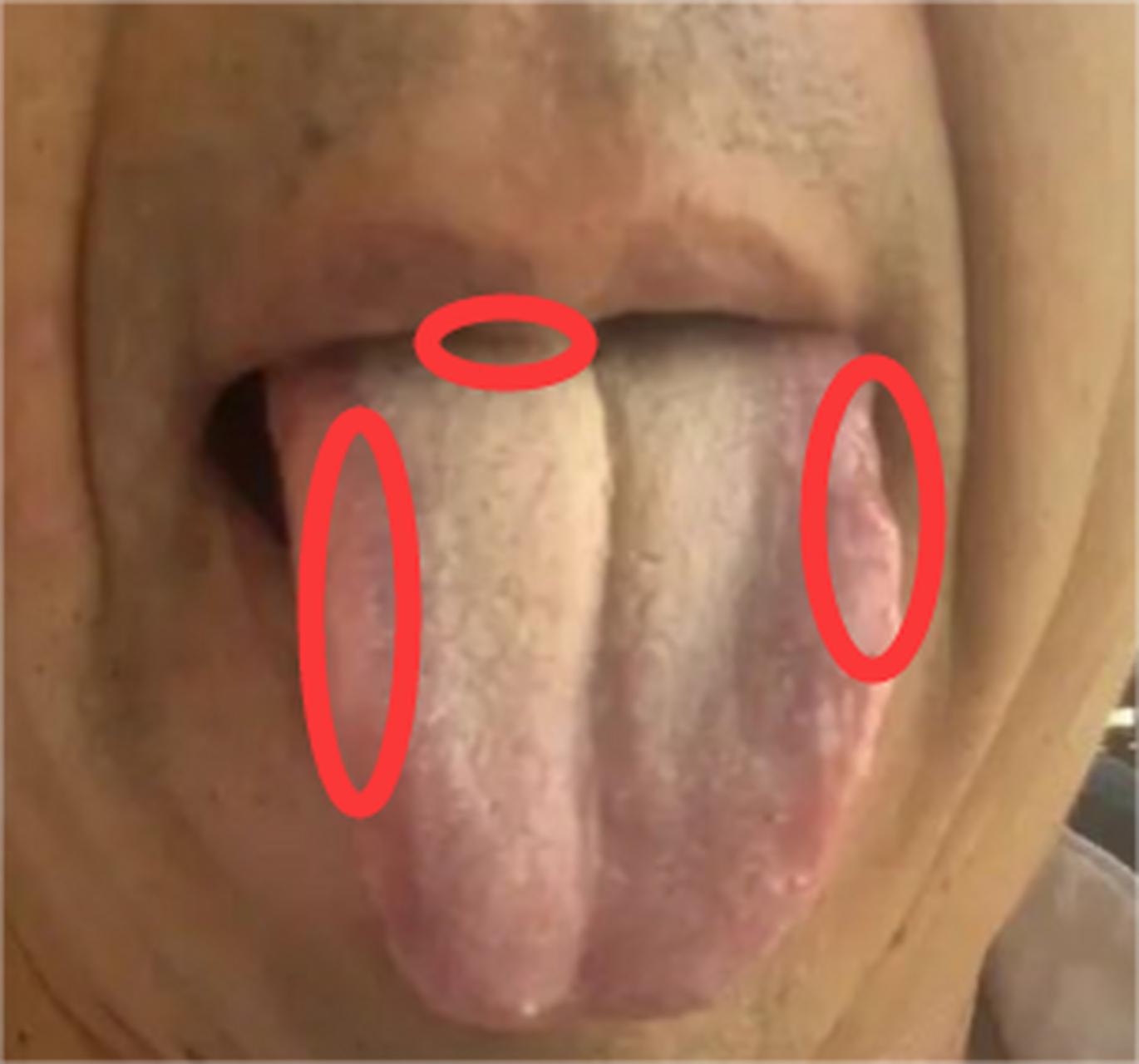 今天给大家分享一个患者舌相  大家可以看到这个舌相两边有明显的鼓胀