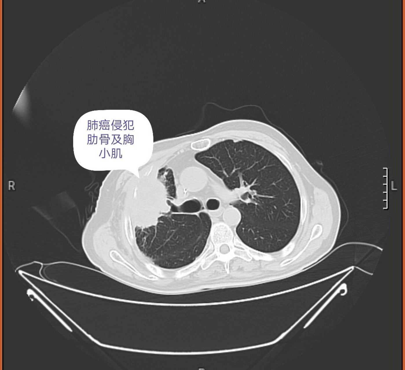 肺癌首发的转移症状基本都是淋巴结转移,先进入淋巴管,随着淋巴管
