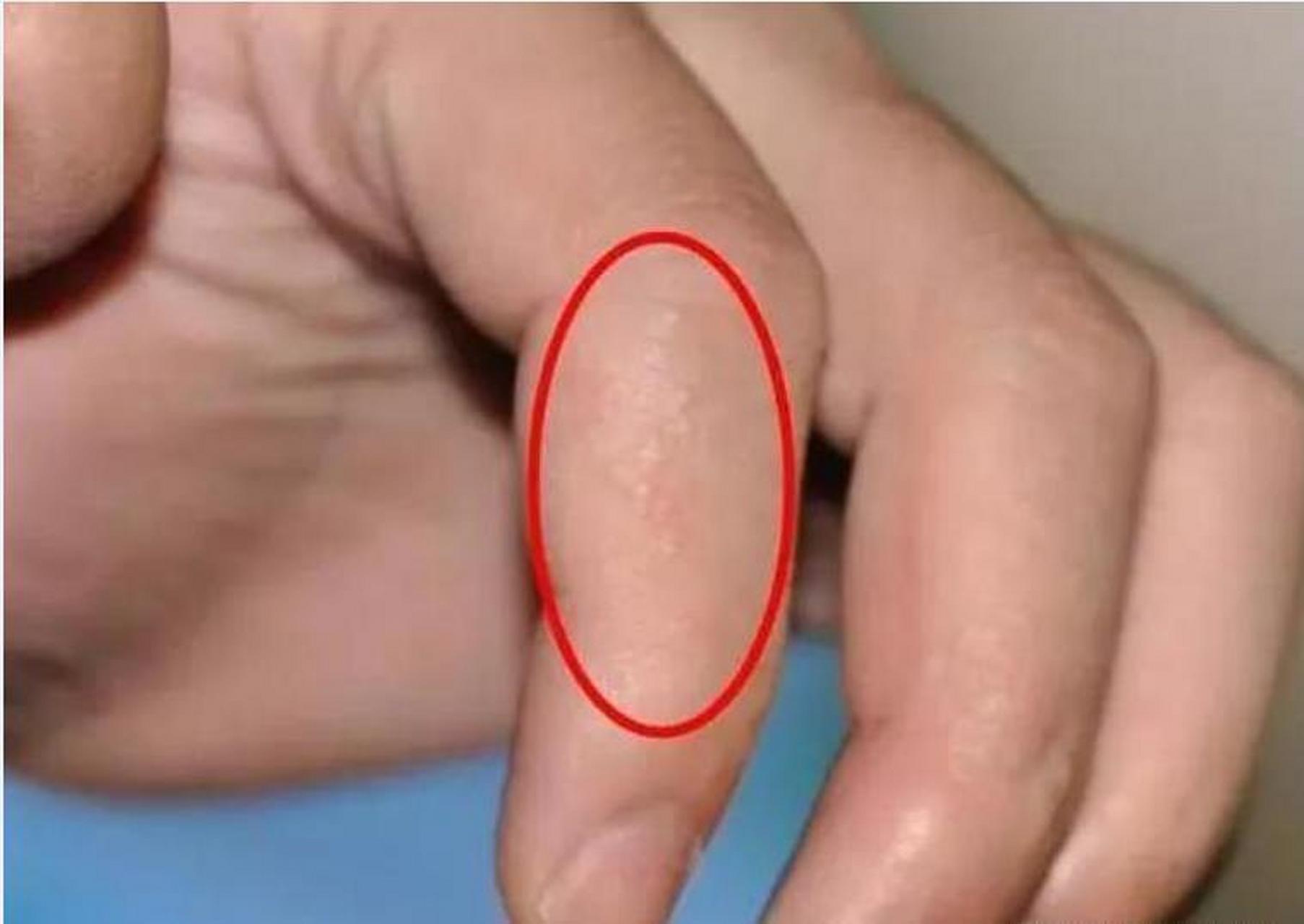 一到夏天,湿气更重,手上频长小水泡?"根源"找到,很多人爱做!