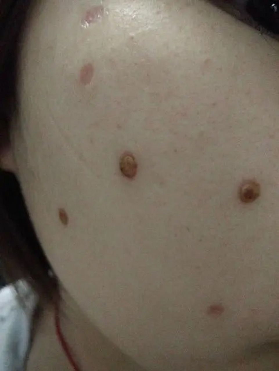 这几乎是每一个点痣的人,都会提出的问题.