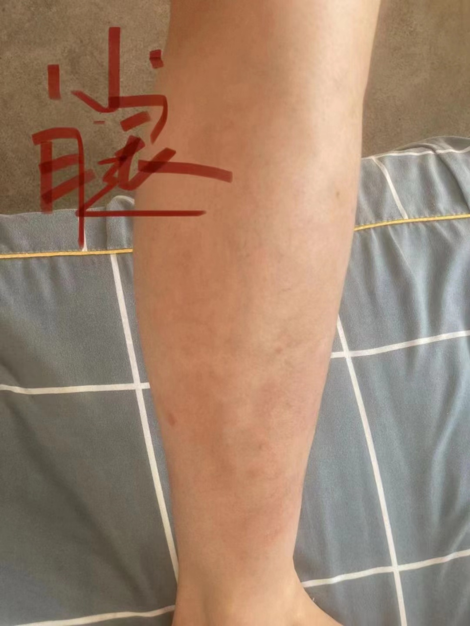 银屑病多年,皮损厚厚的一层,腿上都是鳞屑.