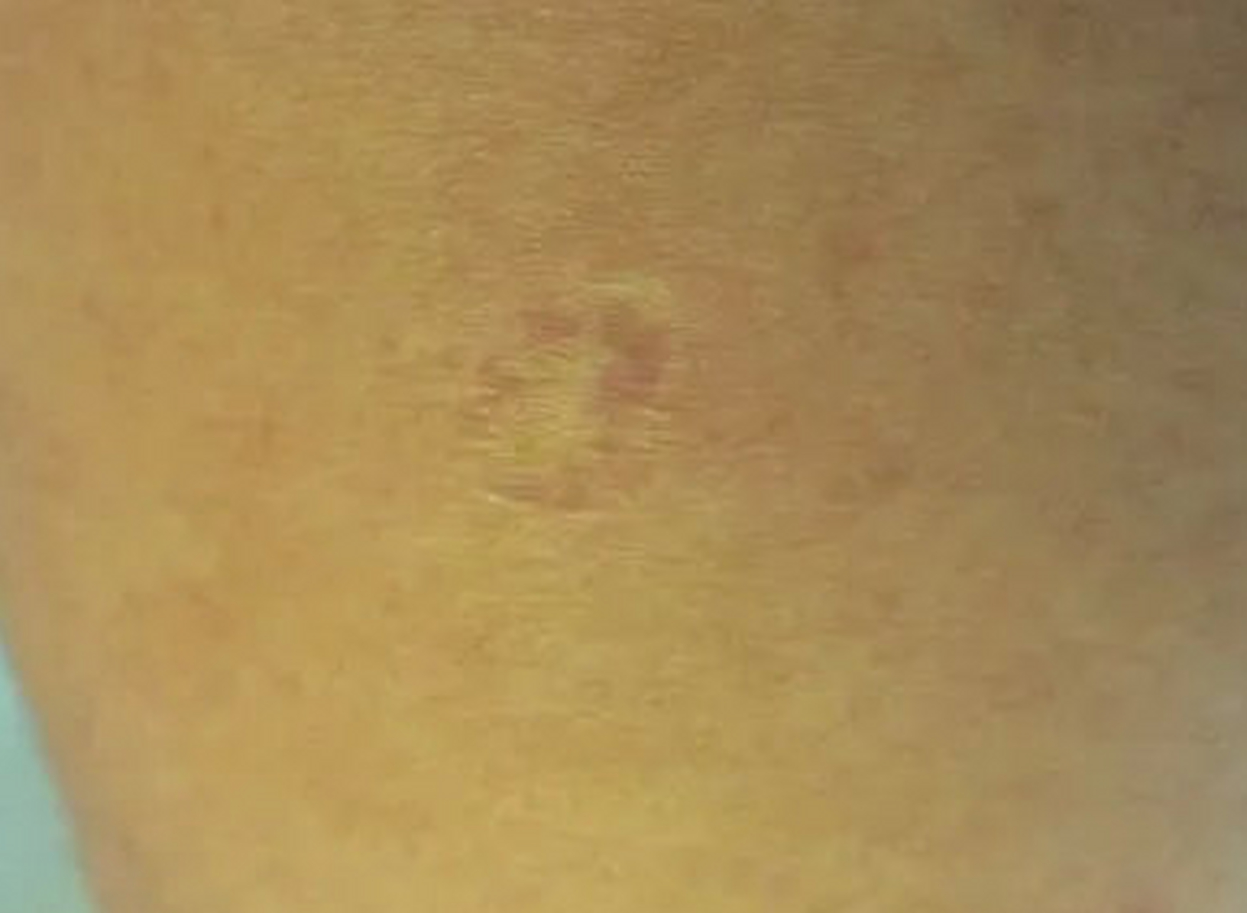 90%的人接种卡介苗后会在胳膊上留下瘀痕,没有留痕不代表接种失败,没