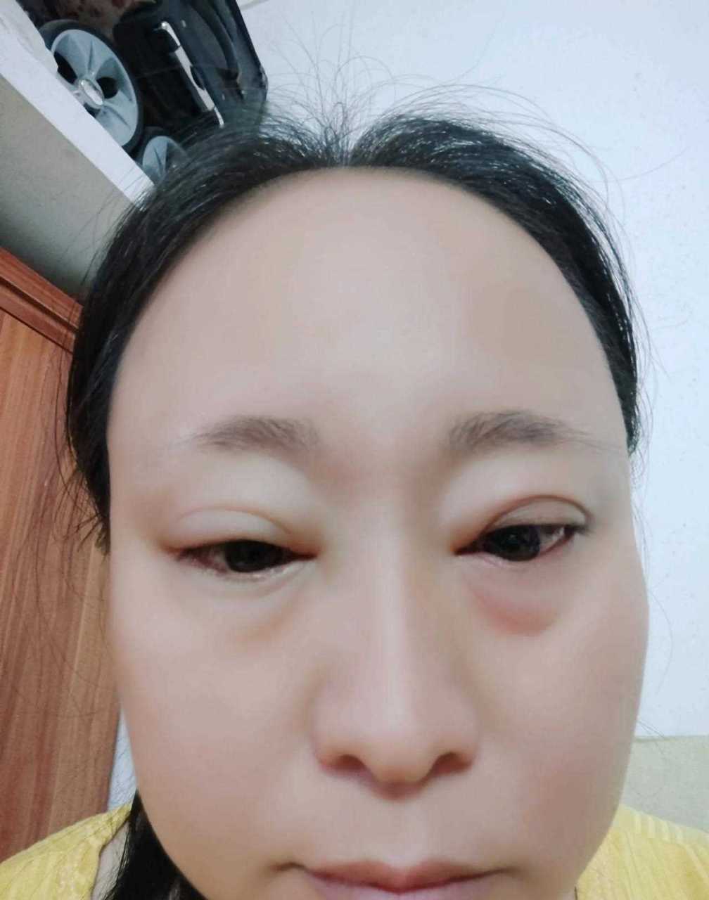 看到镜子里的自己,眼睛竟然肿的看不见.