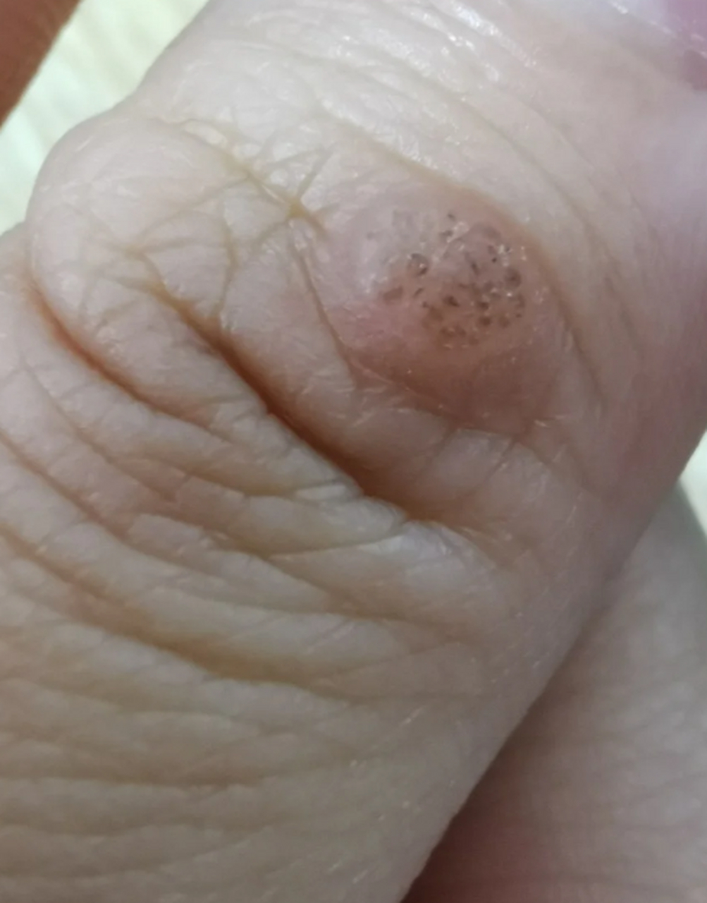 鱼鳞痣怎么去除 #医美科普挑战赛#  鱼鳞痣是一种常见的皮肤病变,通常