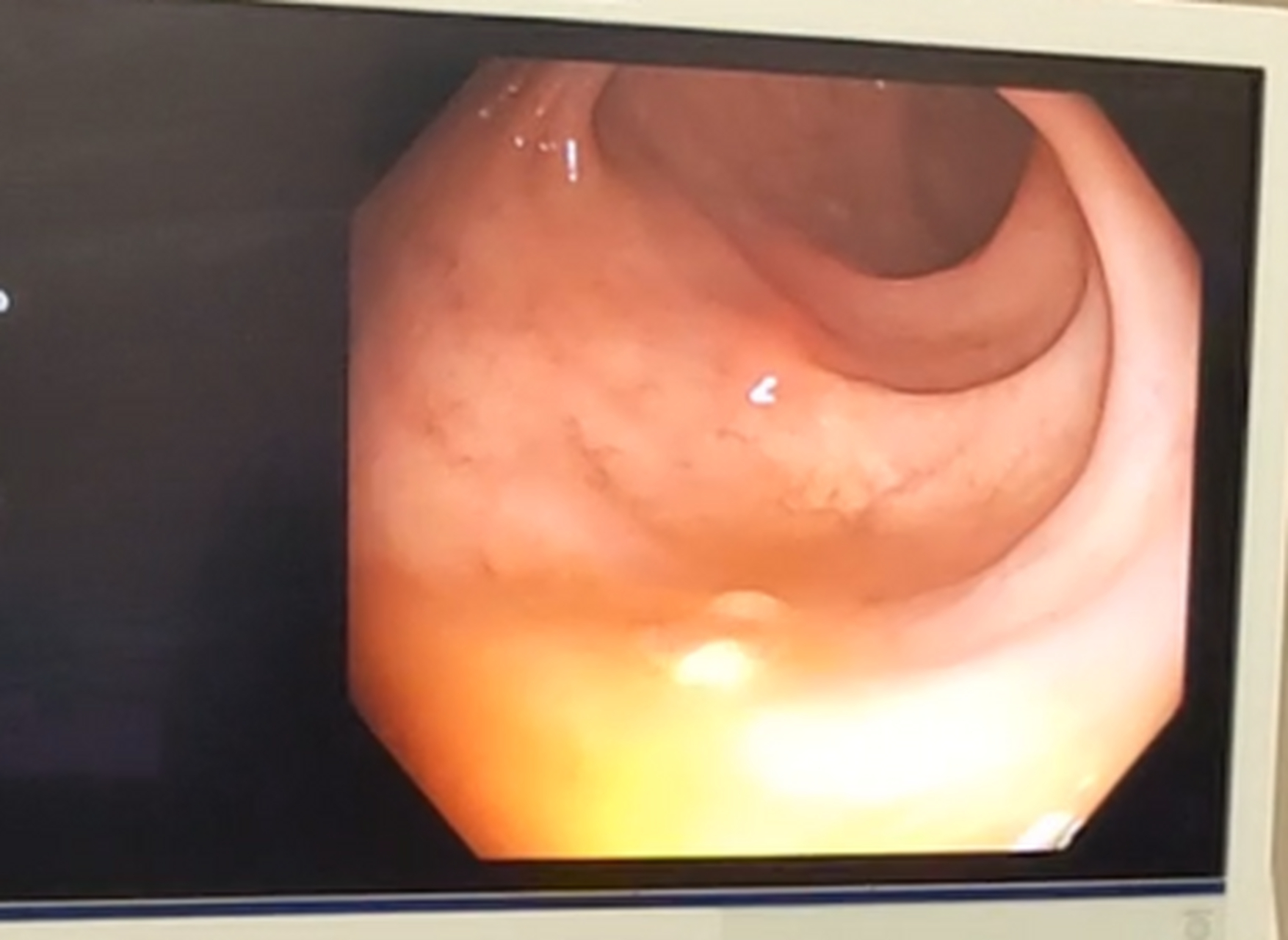 直肠息肉,泛指直肠黏膜表面向肠腔突出的隆起性病变.
