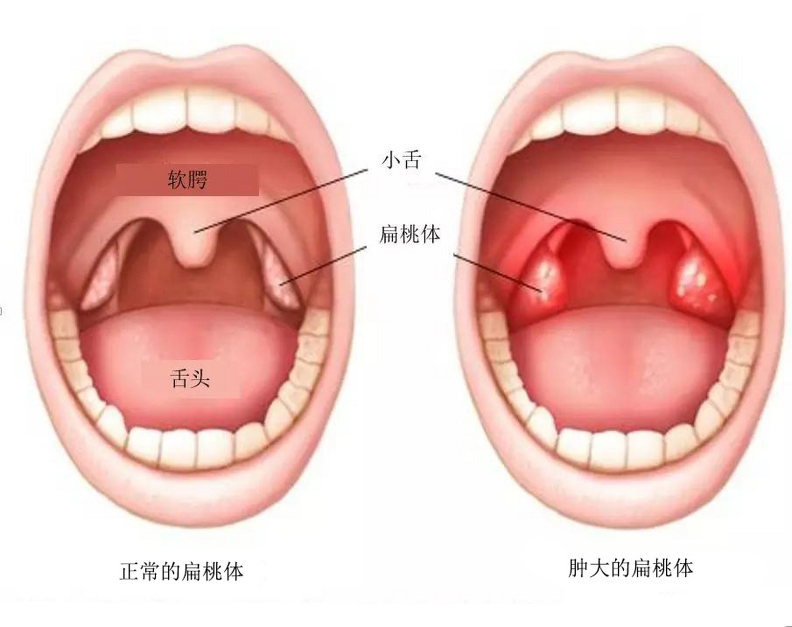 孩子扁桃体肥大,张嘴呼吸打鼾,该怎么办?
