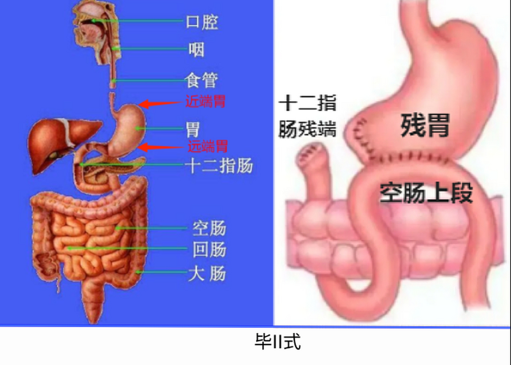 胃癌患者,不同方法切除胃,重建消化道的优缺点: 毕i式(图1): 将下半