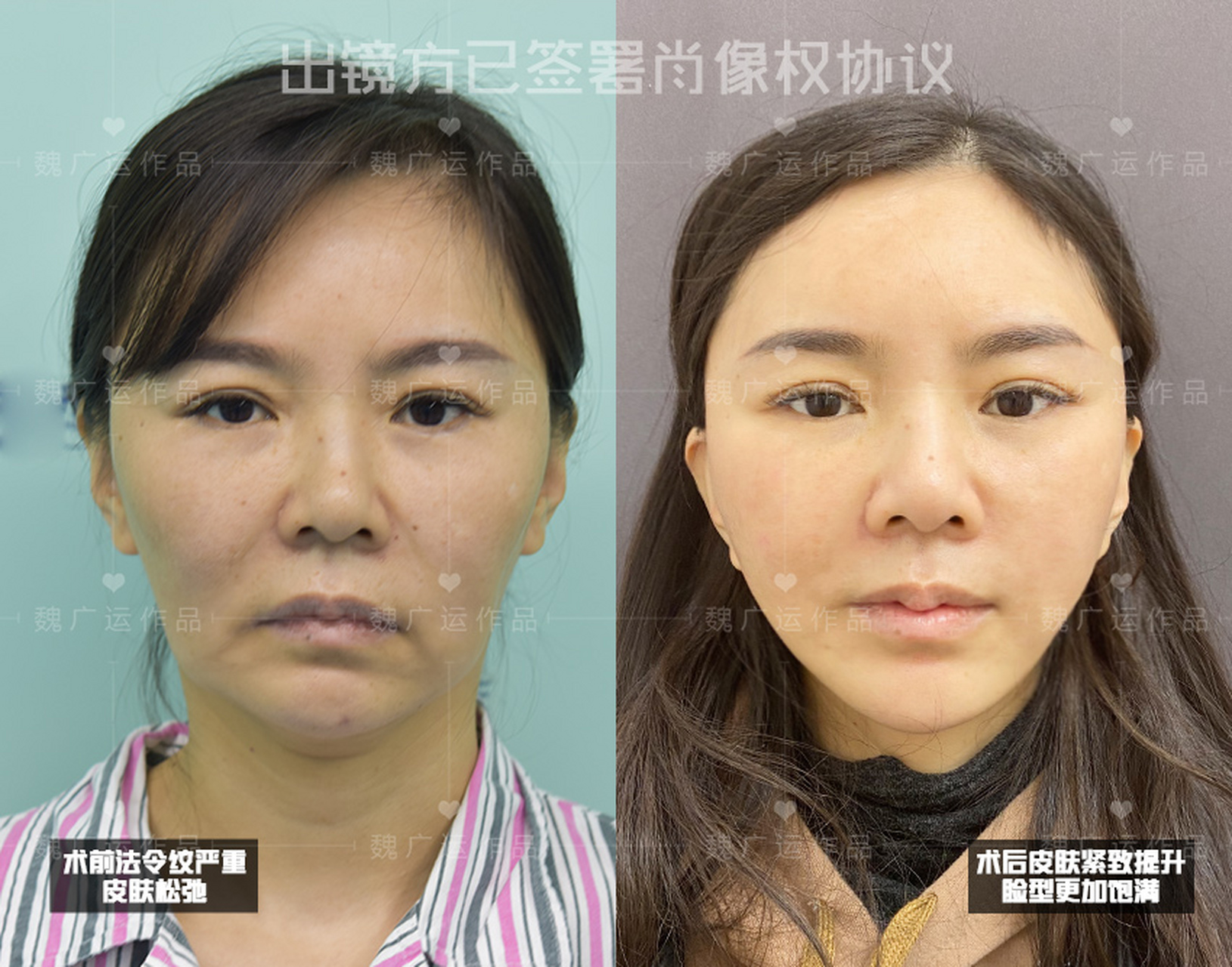 一般而言,拉皮手术的费用会根据以下几个因素而有所差异.