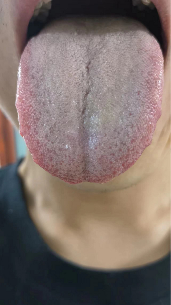 今天我们来看一下这位患者的舌象,舌体胖大,舌边