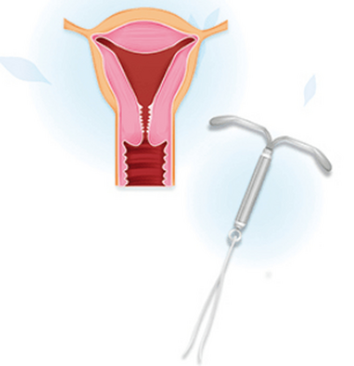 不要以为曼月乐环真的是腺肌症的救星 腺肌症在临床上一般是指子宫腺