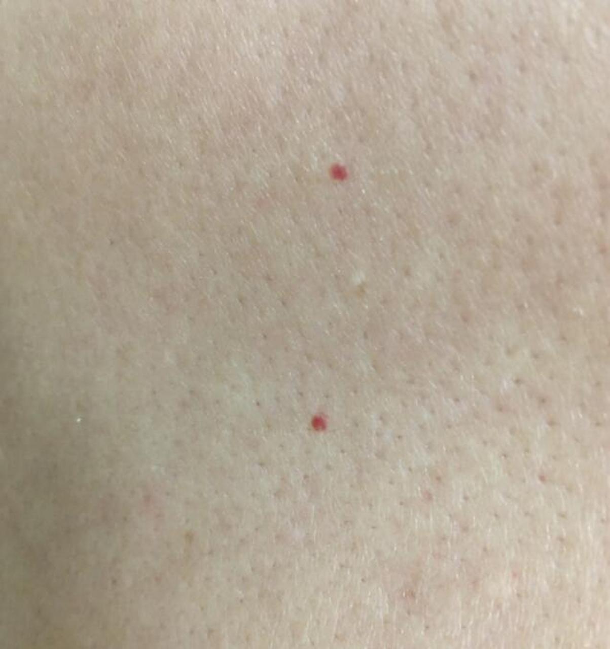 今天有位朋友拍了照片给我,  说自己长了蜘蛛痣是不是肝硬化了  我看