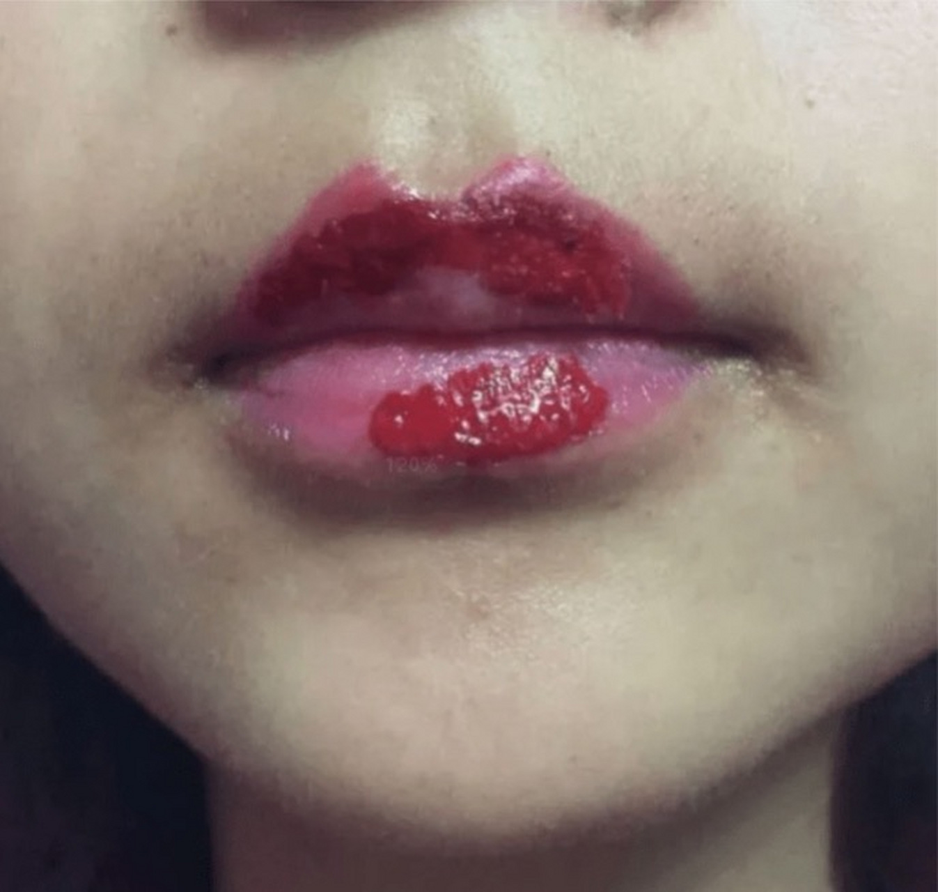 纹唇结痂快速自然脱落小窍门  1,唇部部分痂皮开始慢慢掉落时不要故意