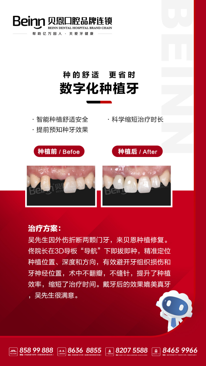 贝恩数字化种植牙案例 患者情况:门牙外伤折断 种植方案:数字化3d种牙