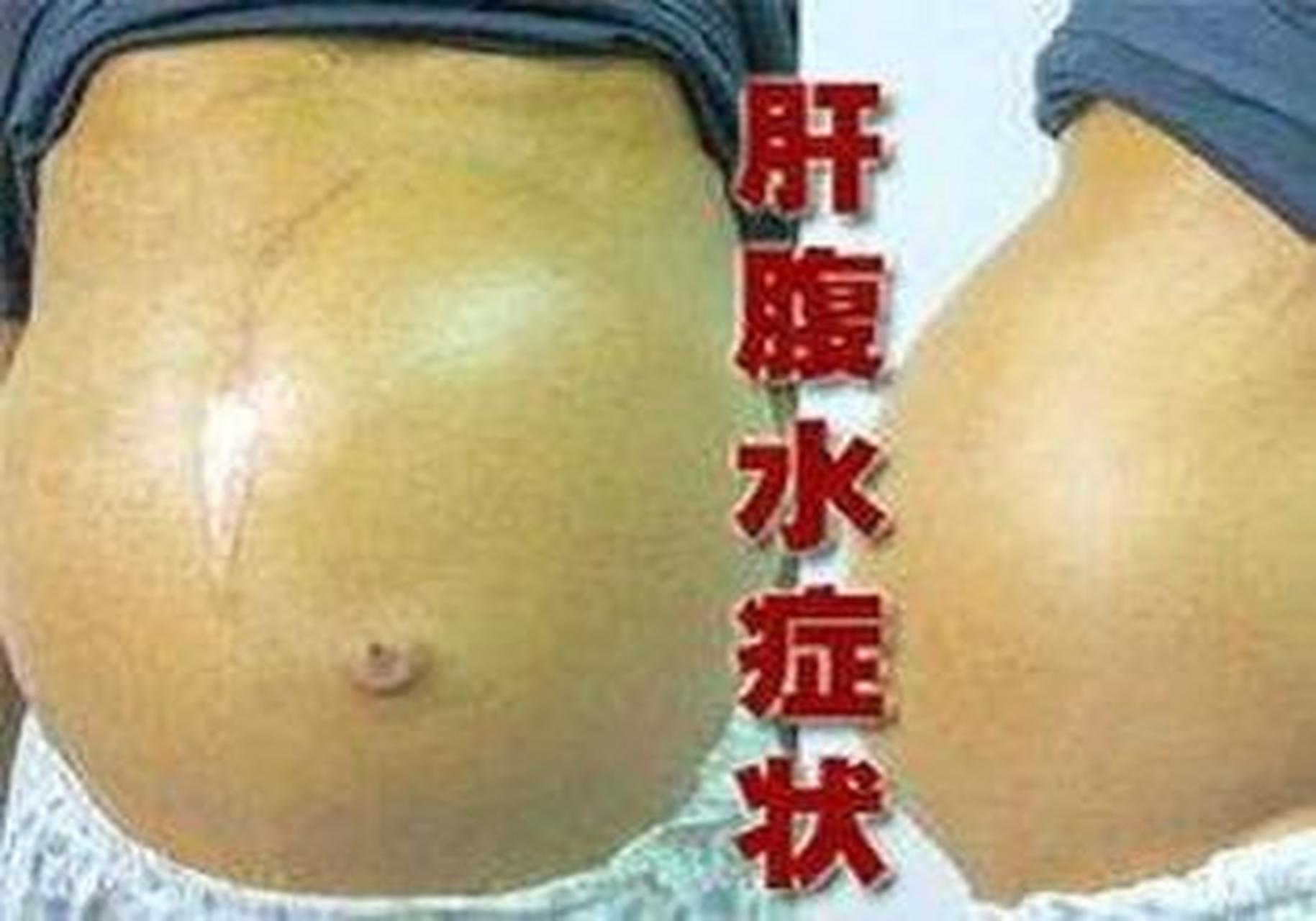 肝硬化出现这4种症状 警惕腹水! 1.