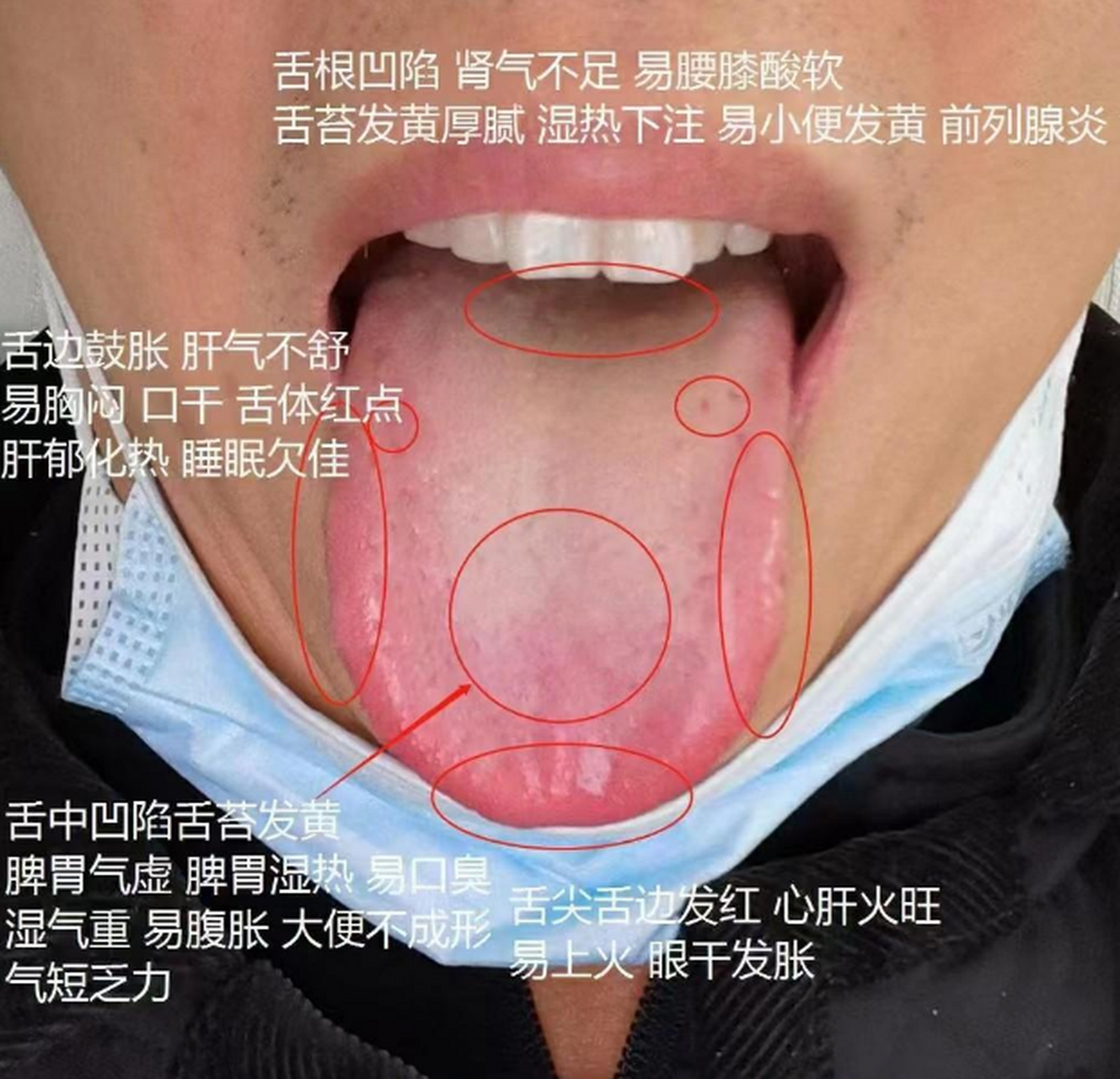 粉丝舌诊,实战分享  (1)舌尖,舌边发红:说明心肝火旺,阴虚生内热了