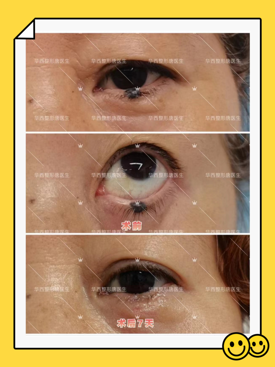 术前:左下睑睑缘黑痣 ​术中:黑痣基底侵及睑板,予以全层切除,术