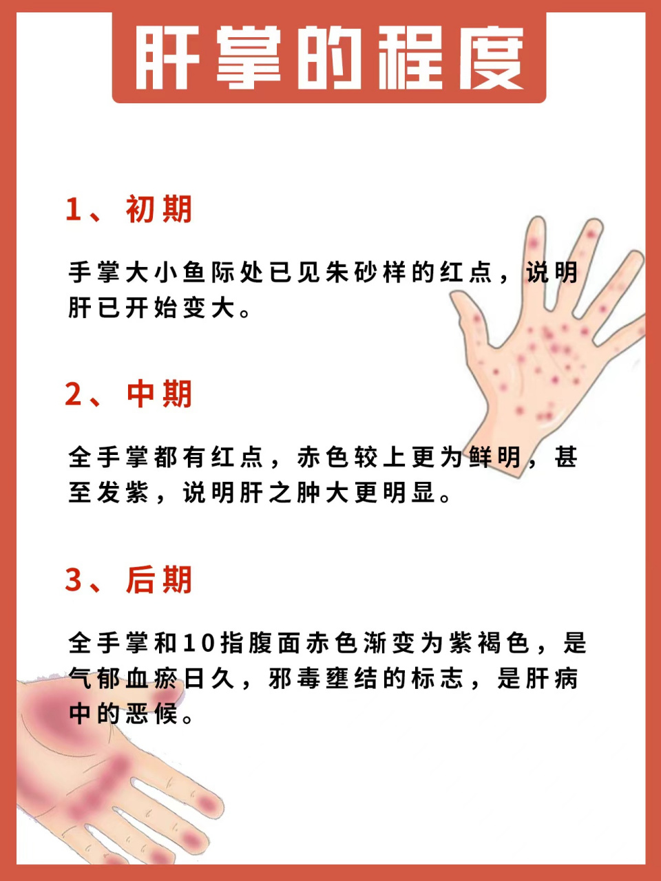 肝脏出了问题,可以从手掌看出#肝掌# #健康科普# #肝病