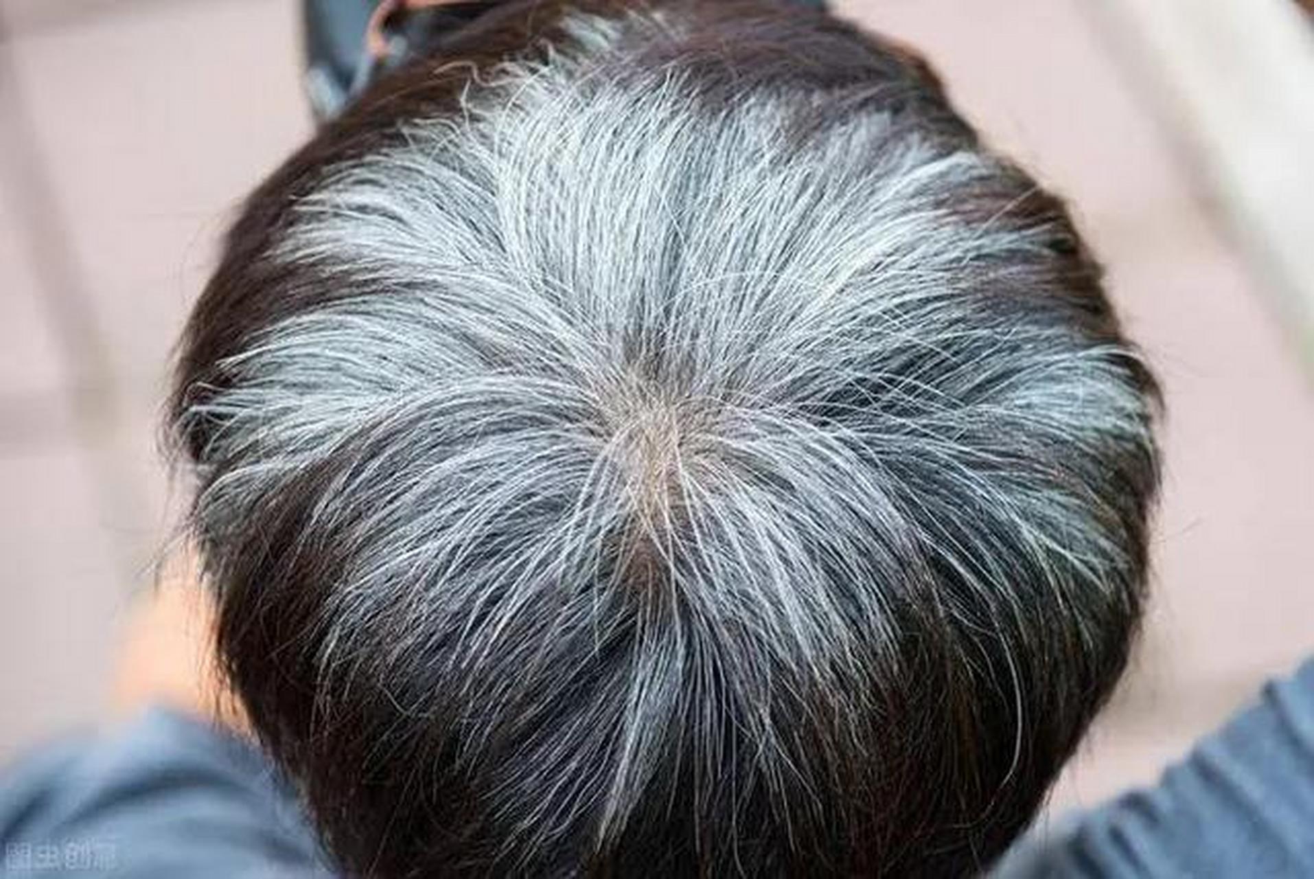 缺乏什么维生素会长白发?涨知识了