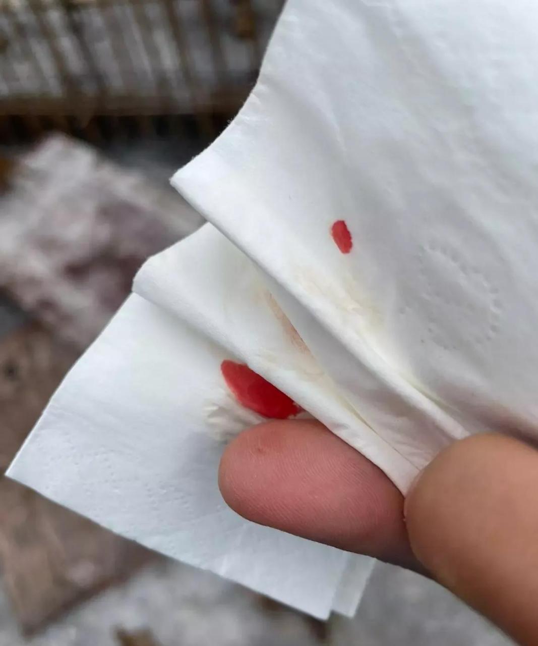 网友:手被这个扎出血了,挂什么科?