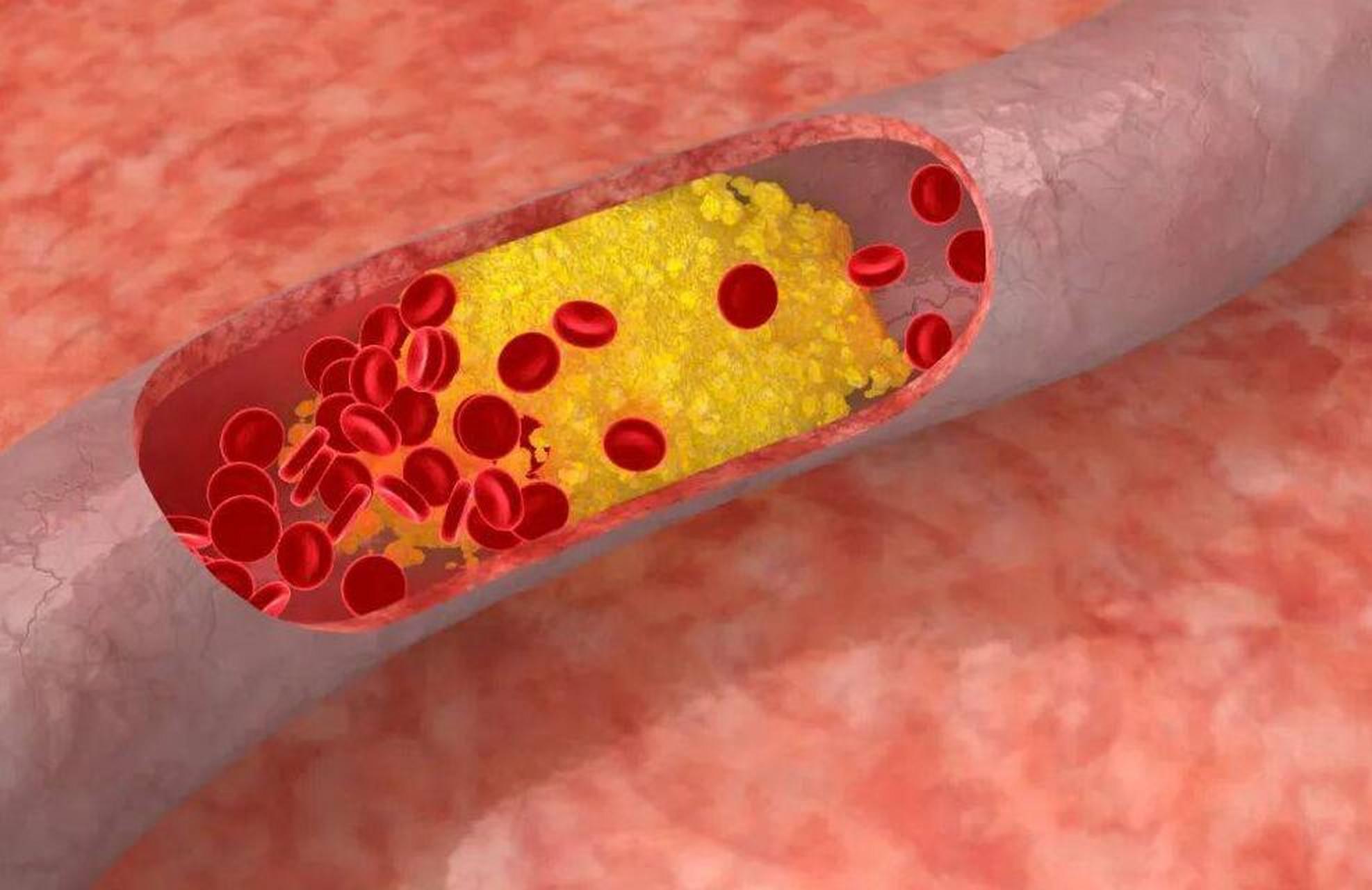 血管淤堵别担心!