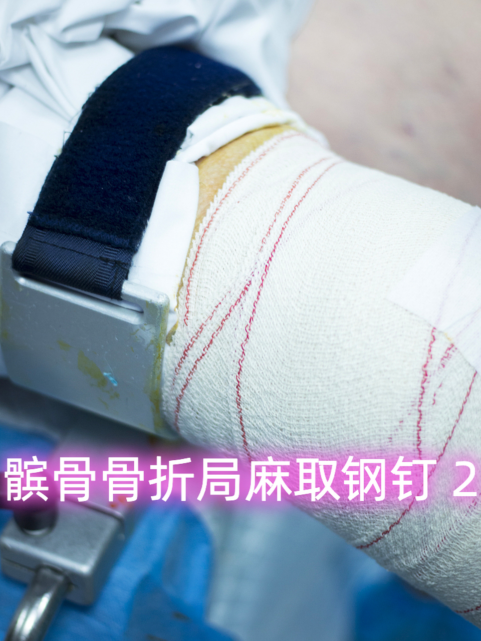 髌骨骨折局麻取钢钉 21566 #髌骨骨折#  #疾病治疗经验#  #健康