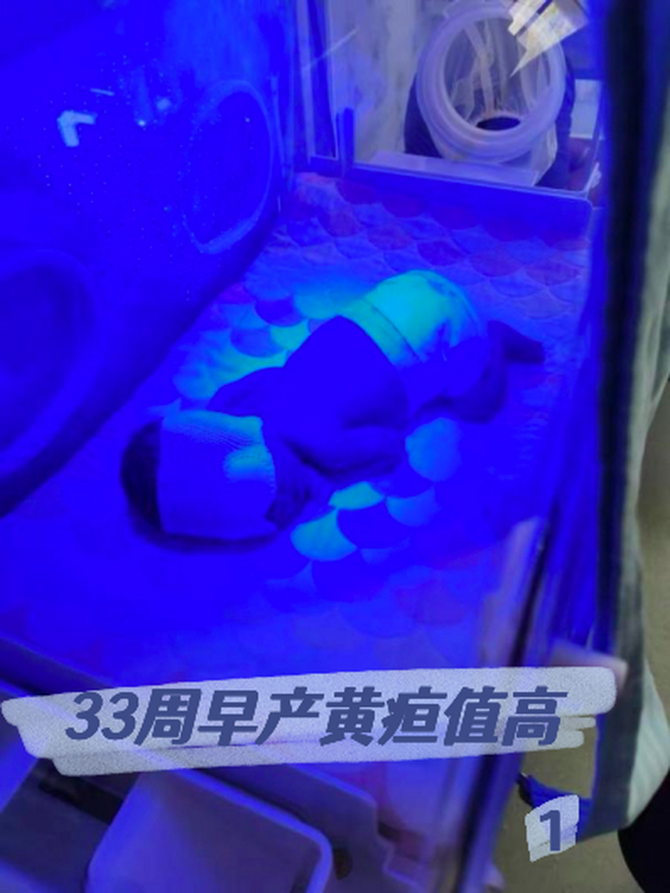 33周早产#早产# 住保温箱黄疸值异常 1 我是33周 6天 晚上上厕所的