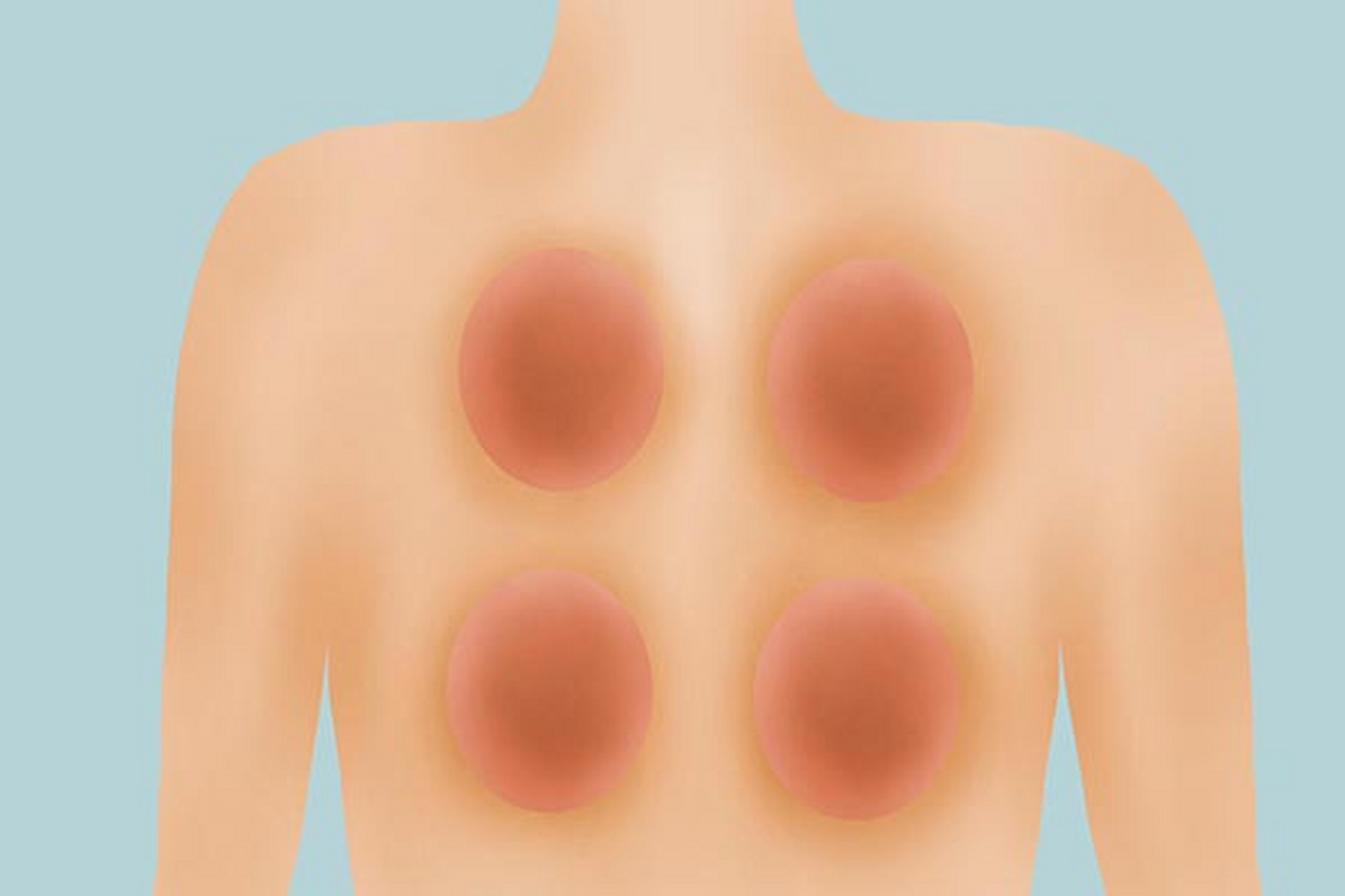 拔罐是中医治疗上的一种方法,主要有散寒祛湿,通筋活络等功效.