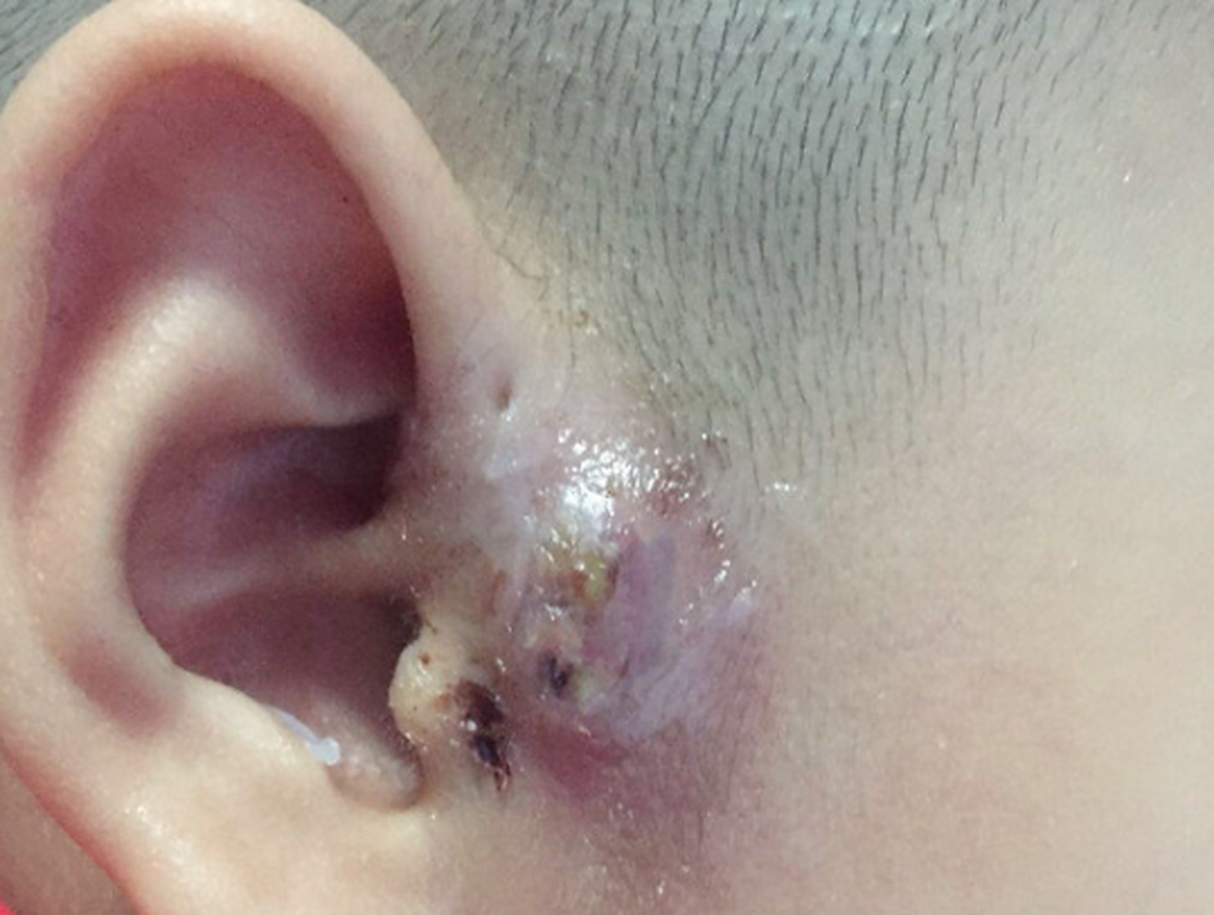 4岁的小男孩,耳朵上长了一个很黑很深的洞,时不时会流脓,爷爷奶奶说这