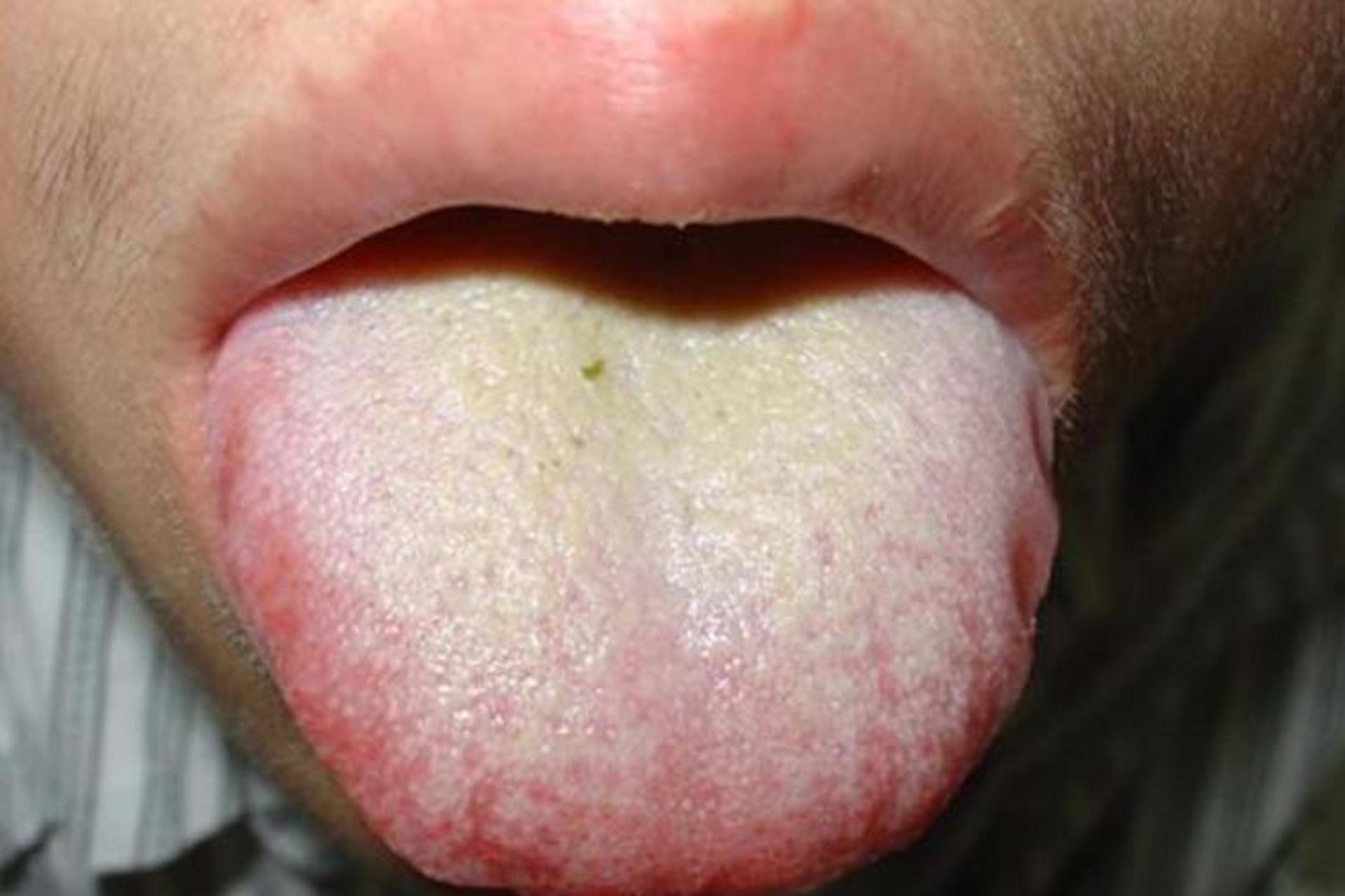 有个患者就是胸闷气短,舌苔黄腻,舌头发红 经常口苦口黏,喝不下水