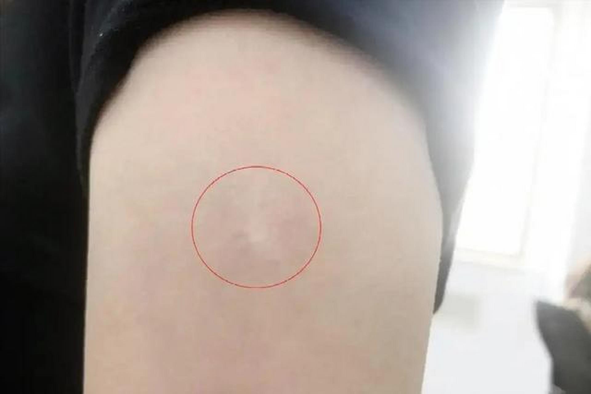 宝宝接种疫苗后,胳膊出现红肿,结节,如何正确处理?