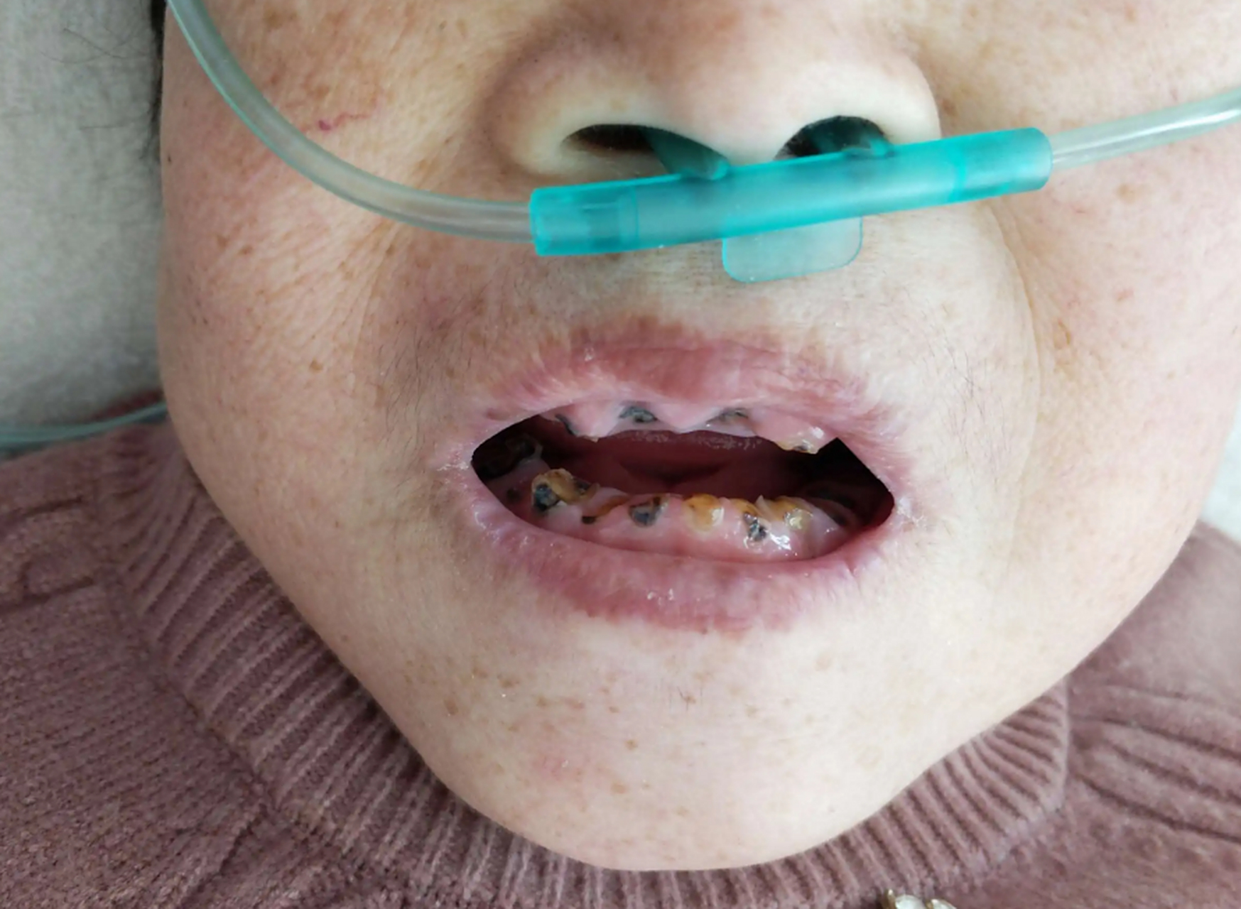 57岁阿姨,一个月内掉了3颗黑色的牙齿,同时觉得皮肤干燥,容易口干口渴