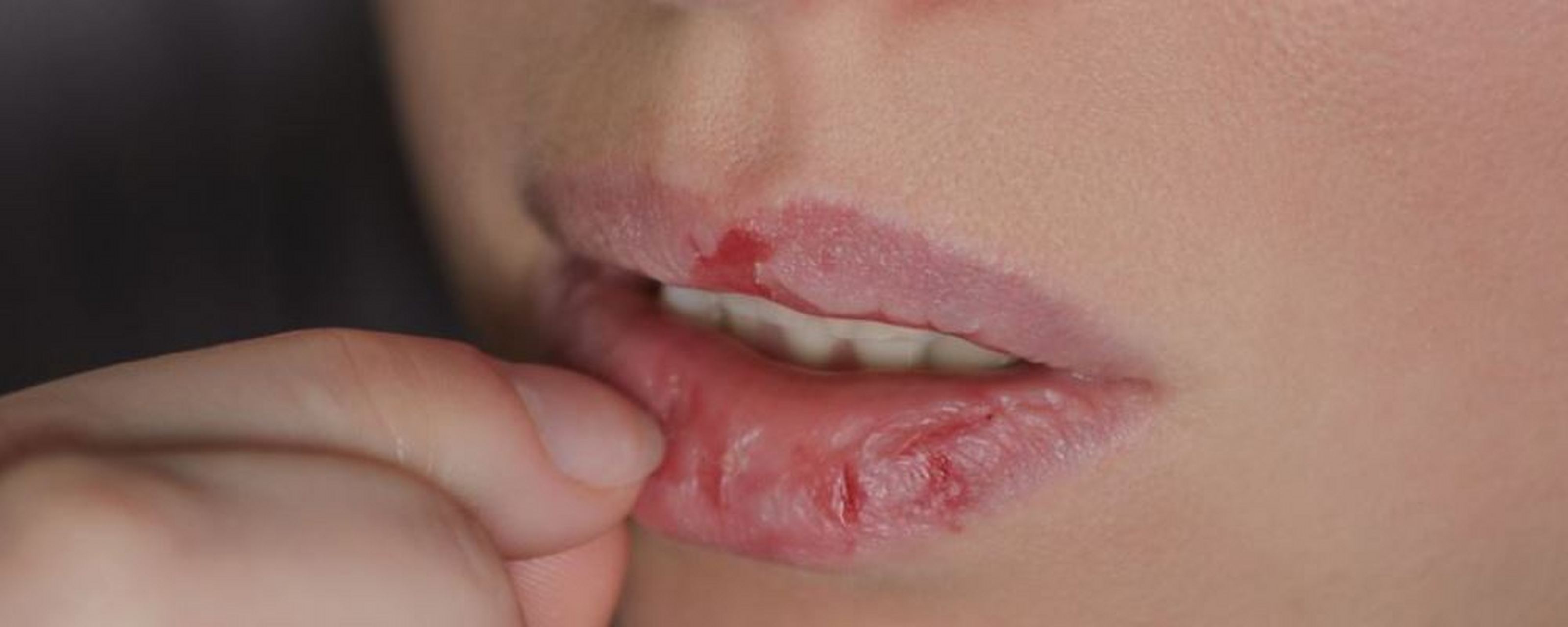 是否有明显的炎症反应,如出现唇部脱屑,肿胀,瘙痒等症状可怀疑是唇炎