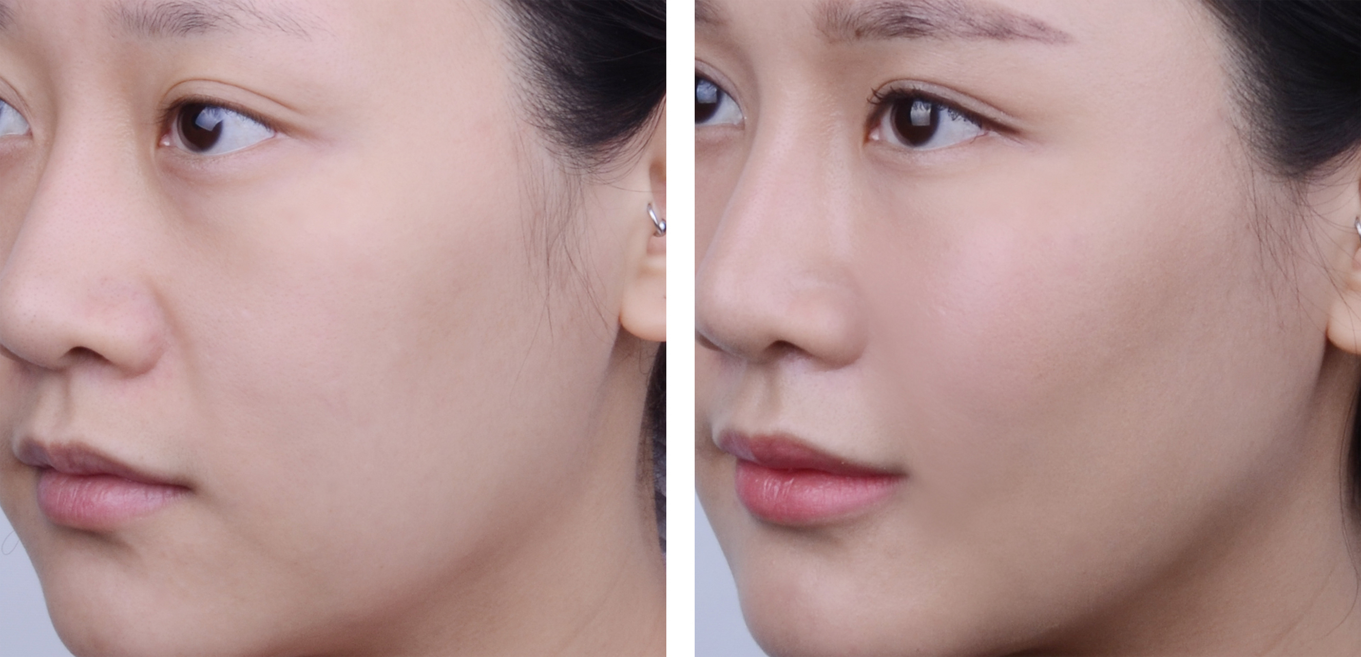 法令纹打玻尿酸多久才能见效 1,创伤程度较轻 法令纹打玻尿酸后,如果