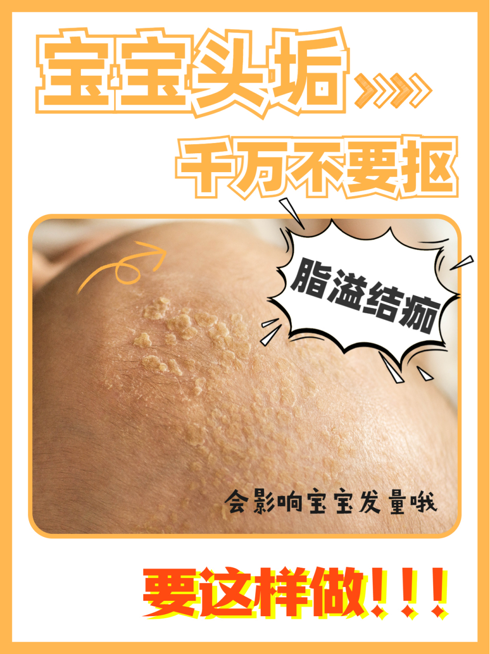 宝宝头垢怎么办?新手爸妈必学#母婴育儿# #新生儿护理# #新手爸妈