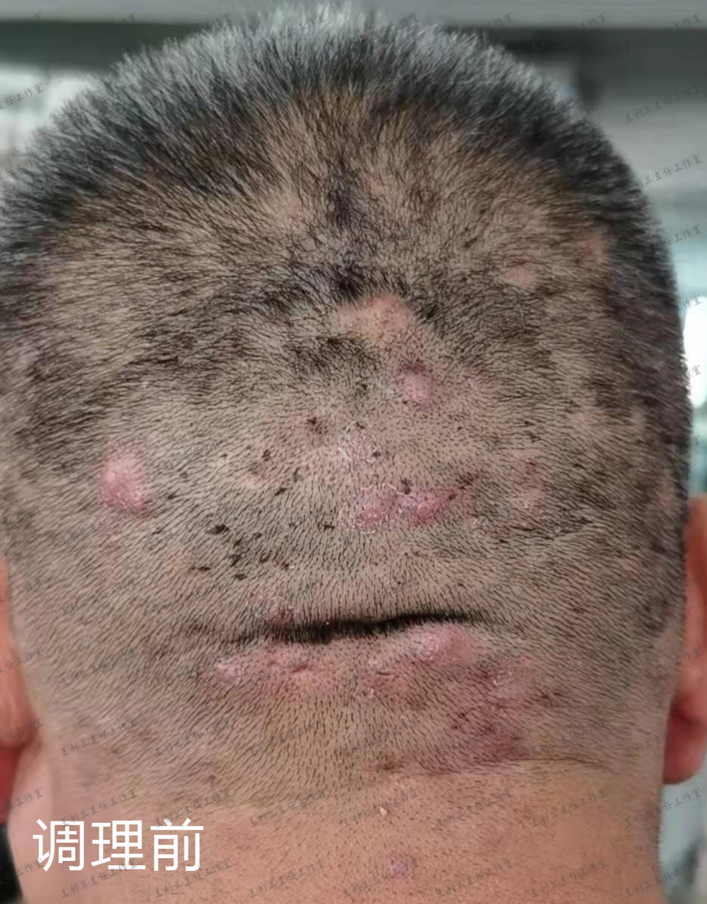 毛囊炎疙瘩消退下去,总算能睡个踏实觉了!