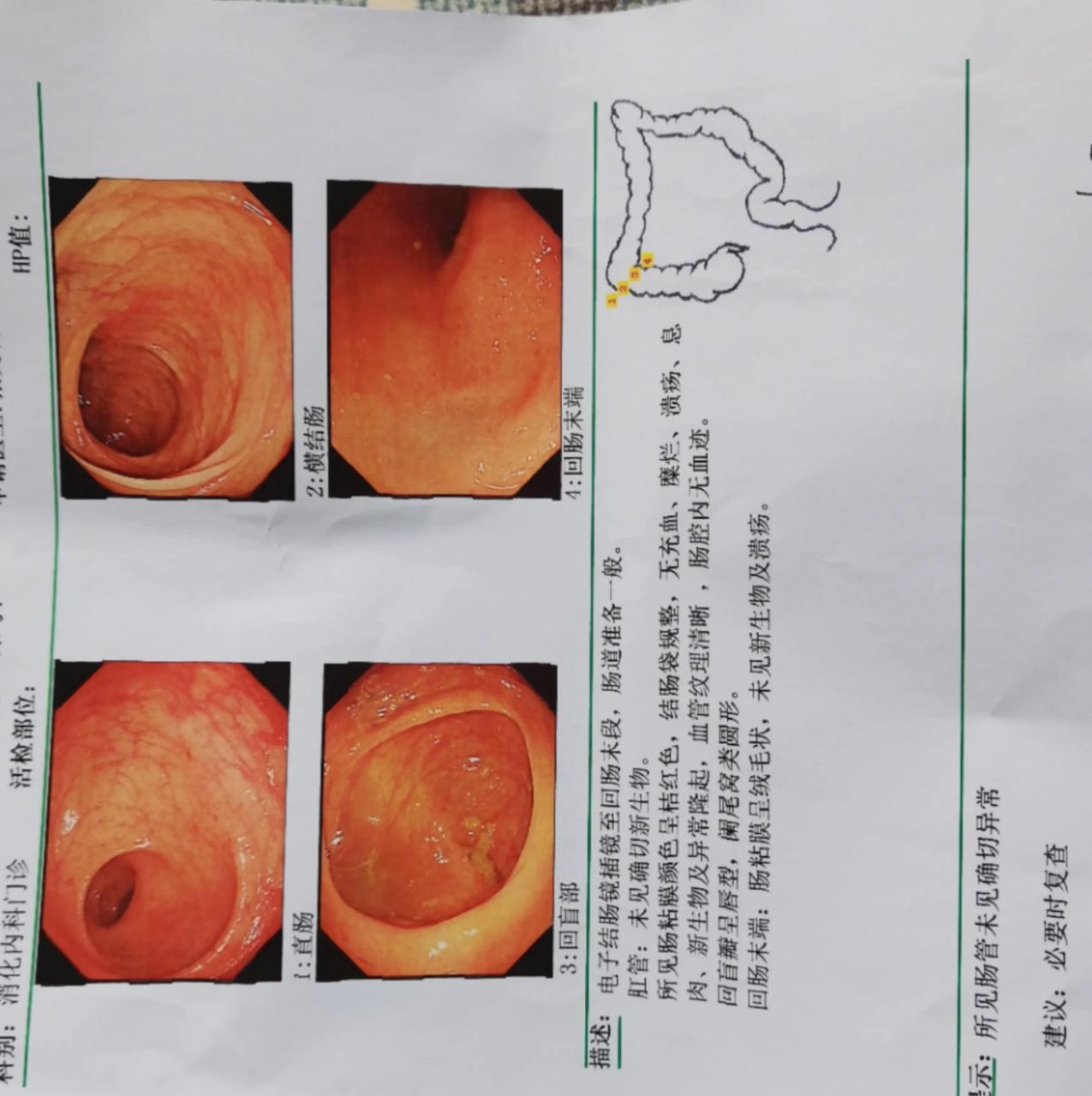 萎缩性胃炎[爆竹] 前年和去年都做了肠息肉手术,今天检查息肉也没有了