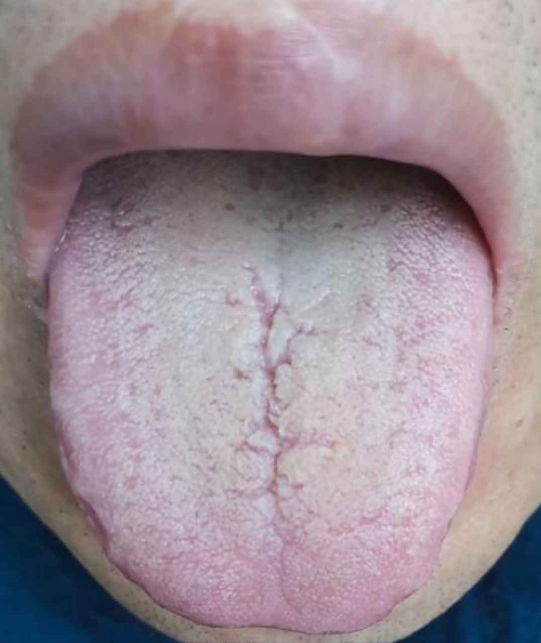 舌中有裂纹,不一定就是脾虚!