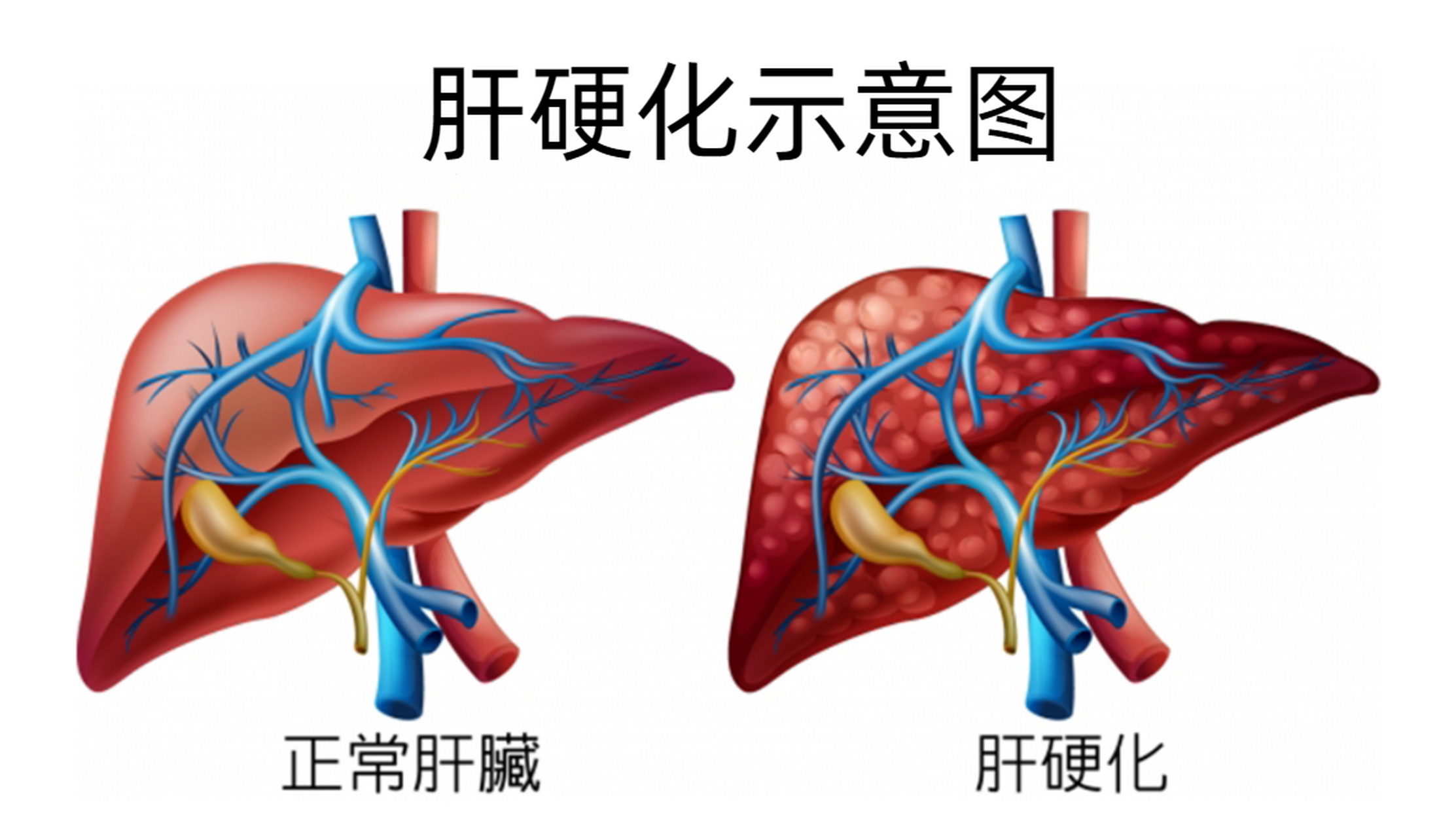 肝硬化的症状及表现图片