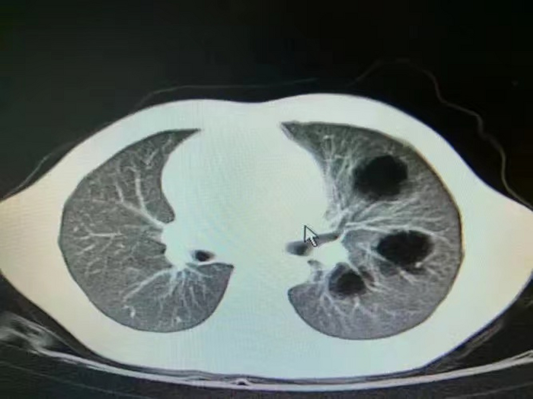   前者亦称为先天性肺囊肿病,是先天性胚胎发育畸形,包括支气管源