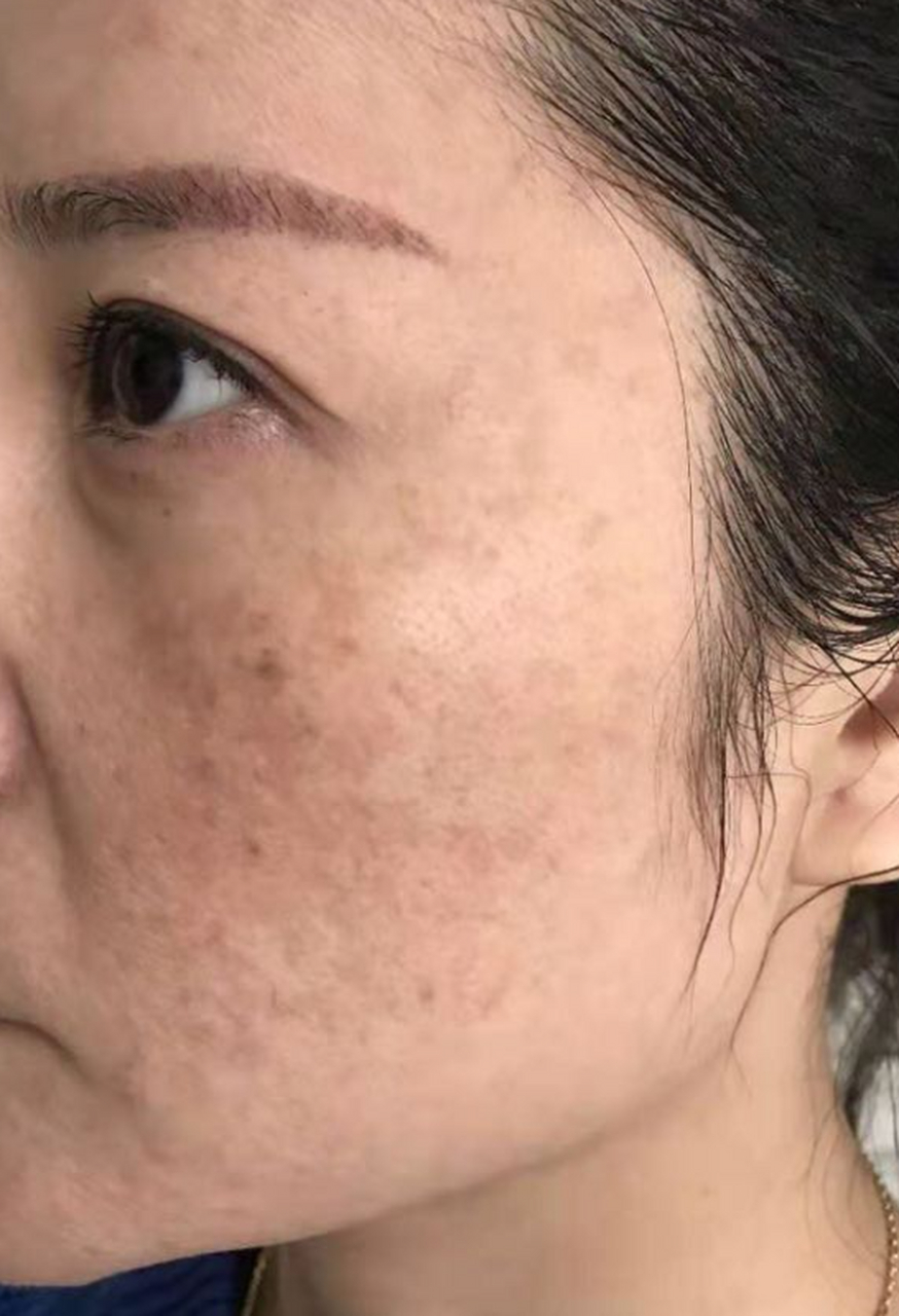 激光祛斑# 黄褐斑和雀斑的区别 黄褐斑和雀斑是两种不同的皮肤问题