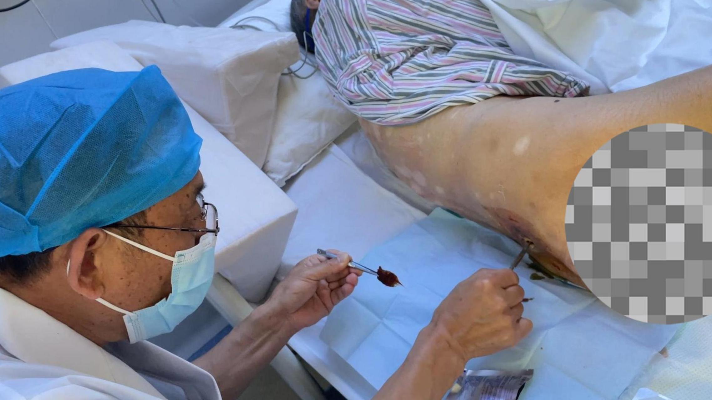 医生# #压疮# 深入骨髓的压疮,每天要做清创处理.