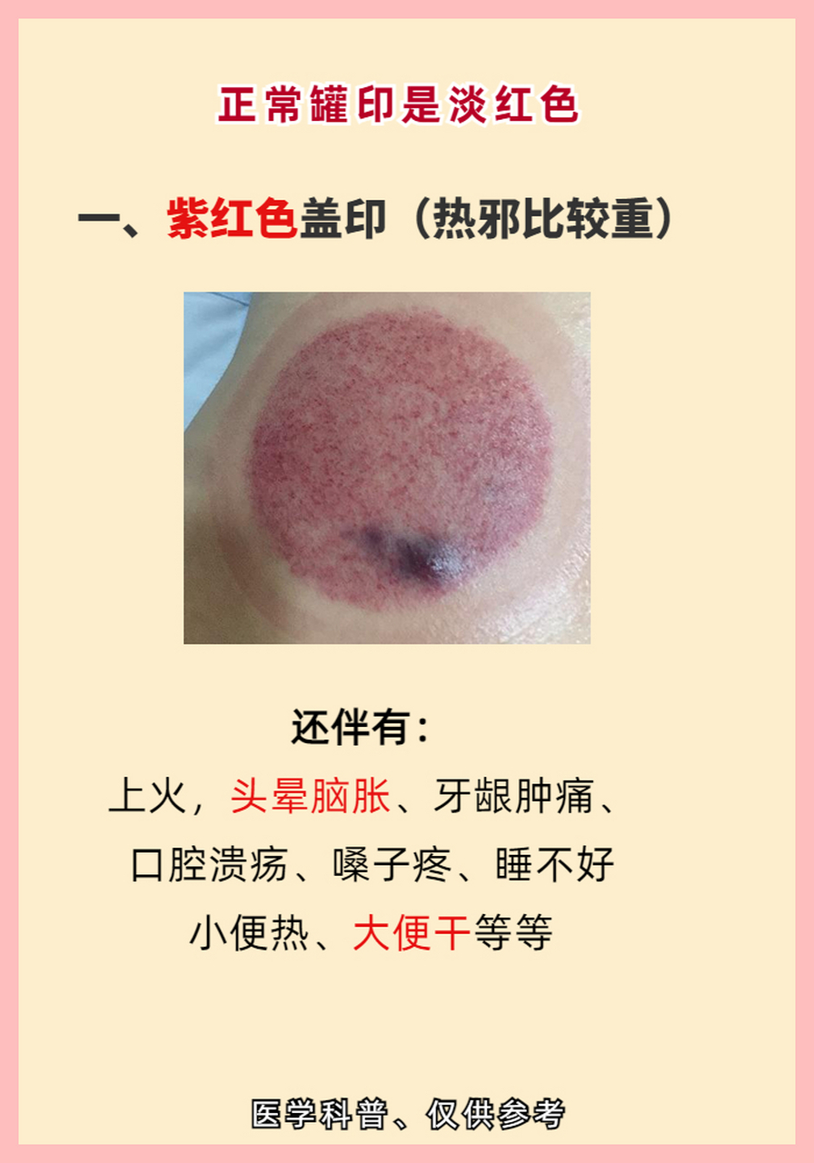 拔罐真的能治病?拔出来黑,紫,青,红各色的罐印都说明什么?